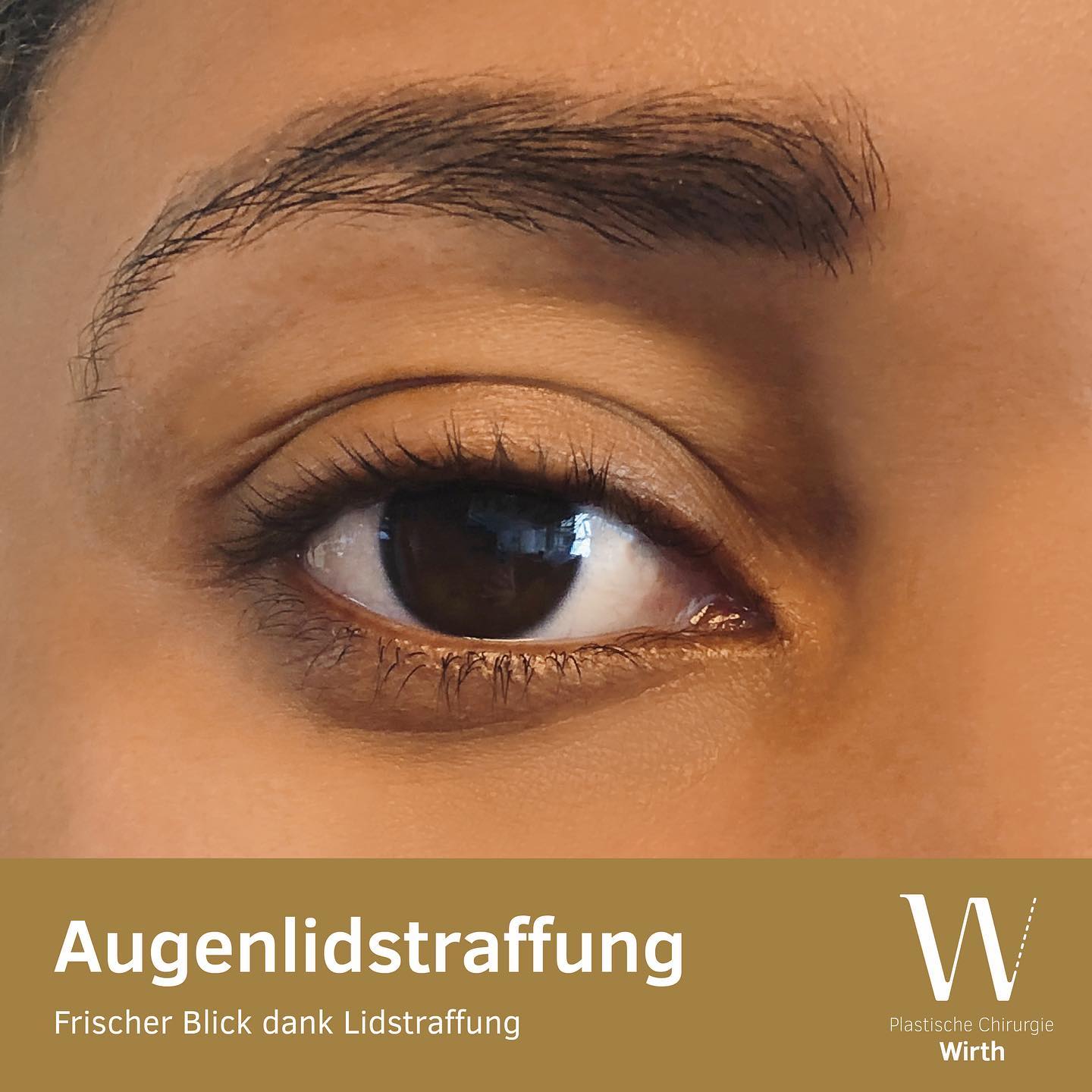 Die Augenpartie ist von zentraler Bedeutung für den Ausdruck und die Attraktivität eines Gesichtes. Mit zunehmendem Alter oder auch angeboren können durch die Erschlaffung der Augenlidhaut und der Lidmuskulatur Schlupflider und Tränensäcke entstehen. Durch eine Lidstraffung wird die Augenpartie und damit der gesamte Gesichtsausdruck verjüngt, der Blick erscheint dadurch wacher ohne dabei „operiert“ zu wirken.
Bei dem als Blepharoplastik bezeichnetem Eingriff wird überschüssiges Haut- und Fettgewebe im Bereich des Ober- oder Unterlides entfernt. Die beiden Eingriffe können sowohl einzeln wie auch kombiniert vorgenommen werden. Die Narben sind in der Regel kaum sichtbar. Bei der Oberlidstraffung liegen die Narben in der Lidfalte und bei der Unterlidstraffung am Lidrand unter den Wimpern. Mitunter ist es erforderlich, die Position der Augenbrauen ebenfalls gleichzeitig zu korrigieren, um ein schönes Resultat zu erhalten.
Les yeux sont une partie essentielle par rapport à l’expression et l’attractivité d’un visage. Avec l’âge ou pour des raisons héréditaires, le relâchement de la peau et de la musculature des paupières peut alourdir le regard ou provoquer des poches sous les yeux. Le lifting des paupières rajeunit non seulement le regard, mais aussi l’expression du visage en général. Le regard devient plus vif, sans pour autant paraître «opéré».
La blépharoplastie consiste à supprimer, par intervention chirurgicale, les excès de peau et du tissu graisseu dans la zone des paupières supérieures ou inférieures. Ces deux opérations peuvent être effectuées separament ou en combinaison. Normalement, les cicatrices restent à peine visibles Elles se situent, lors d’une blépharoplastie supérieure, dans le pli de la paupière, et, lors d’une blépharoplastie inférieure, en bordure de la paupière, sous les cils. Pour résultat optimal, il peut s’avérer nécessaire de corriger en plus la position des sourcils.
#praxiswirth #raphaelwirth #plastischechirurgie