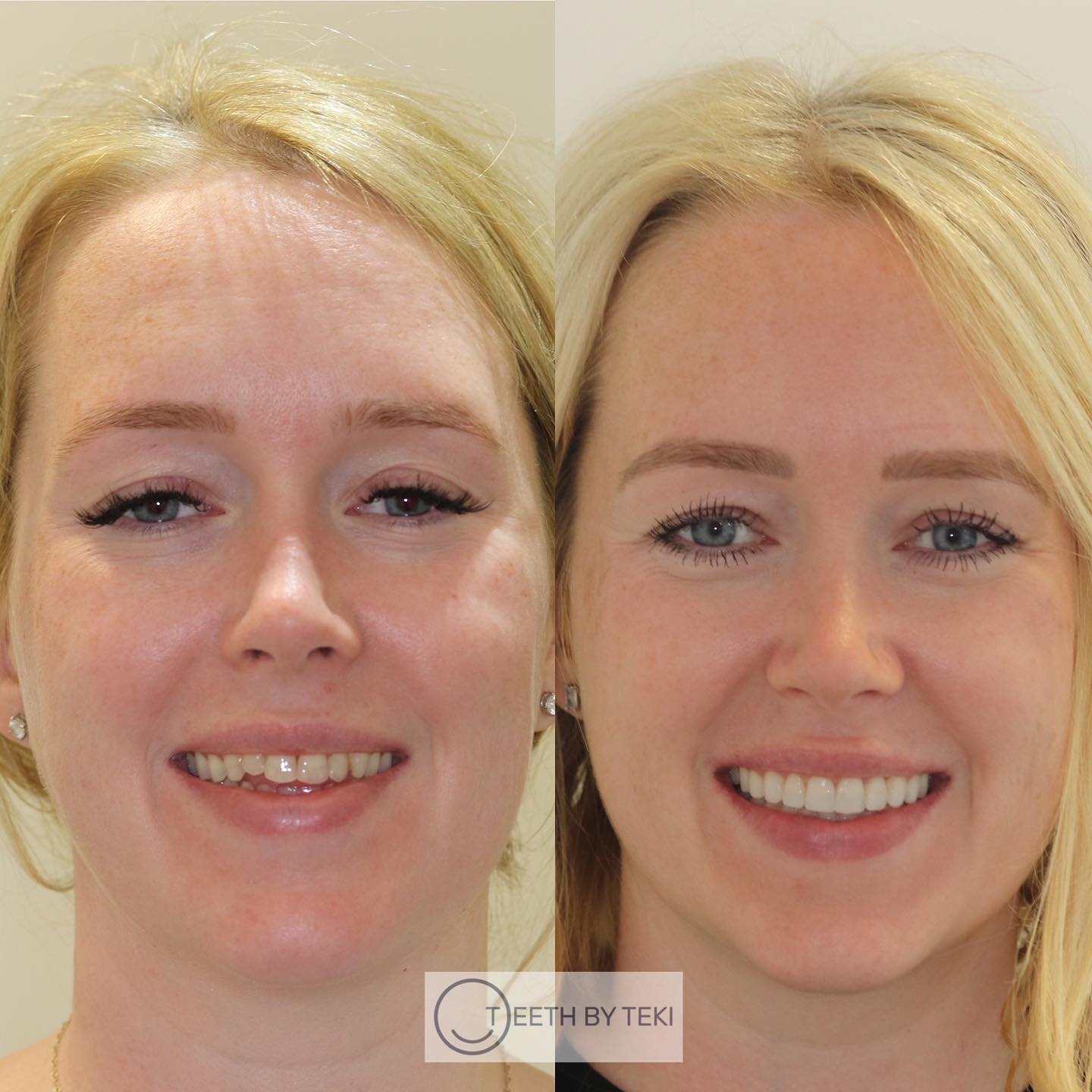 Planned to suit the face 😄
.
.
Invisalign for straightening and bite correction. Composite bonding to suit the patient ⚪️💙
.
.
Your Style Your Smile
#teethbyteki