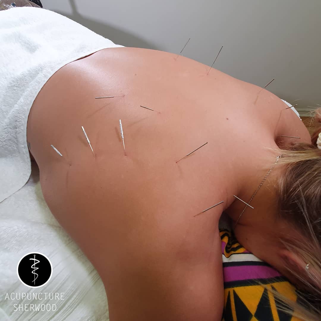 #acupuncture #acupuncturelife #acupuncturedoctor #acupunctureworks #acupunctureneedles #acupuncturerocks #acupuncturist #acupuncturebrisbane #shoulderpain #shoulderpaintreatment #acupuncturesherwood