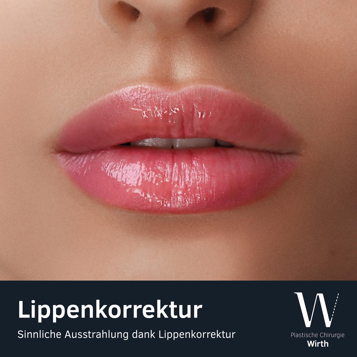 Lippenkorrektur
Schön geformte Lippen können Ihr Aussehen wie kein anderes Merkmal aufwerten und Ihnen eine besondere, sinnliche Ausstrahlung schenken. Mit zunehmendem Alter verlieren auch die Lippen an Volumen und Geschmeidigkeit. Sie werden schmaler, es bilden sich Falten im Mundbereich, die Mundwinkel ziehen nach unten. Aber auch in jüngerem Alter können schmale oder asymmetrische Lippen vom Patienten als störend empfunden werden. Hier kann durch einen individuell geplanten Volumenaufbau der Lippen eine harmonische oder vollere Form erreicht werden, passend zu den Proportionen des gesamten Gesichtes. Die Ergebnisse der Lippenkorrektur sollten natürlich erscheinen und lange anhalten.
Mehr Informationen - Link in der Bio
Correction des lèvres
De belles lèvres bien formées peuvent améliorer votre apparence, comme aucune autre partie du visage, et vous donner un aspect particulier et sensuel. Avec l’âge, les lèvres perdent aussi de leur volume et souplesse. Elles deviennent plus fines, des rides se forment autour de la bouche et les coins de la bouche tombent. Néanmoins, les lèvres étroites ou asymétriques peuvent être perçues comme dérangeantes déjà à un plus jeune âge. Ici, une correction individuelle des lèvres visant à leur redonner du volume, une forme harmnieuse et les rendre plus pulpeuses, tout en repectant les proportions du visage, peut être la soulution.
Plus d‘informations - lien dans la bio
#praxiswirth#drmedraphaelwirth#plastischechirurgie