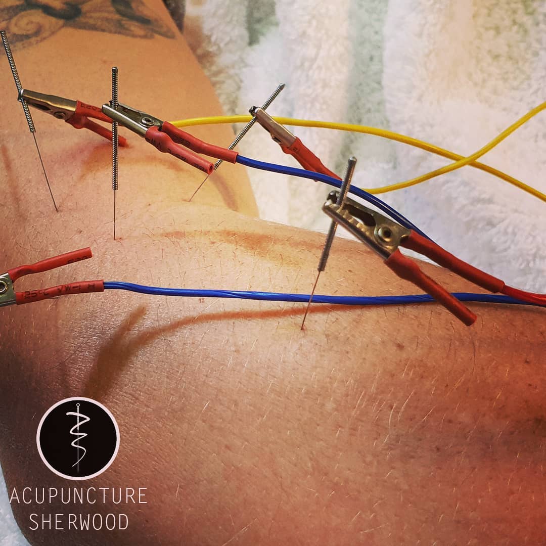 For all sorts of elbow pain...
#acupuncturelife #acupunctureneedles #electroacupunture #acutepain #chronicpain #acupuncture #acupuncturedoctor #acupuncturist #elbowpain #elbowpainrelief #acupunctureworks #acupuncturerocks #acupuncturebrisbane #acupuntura