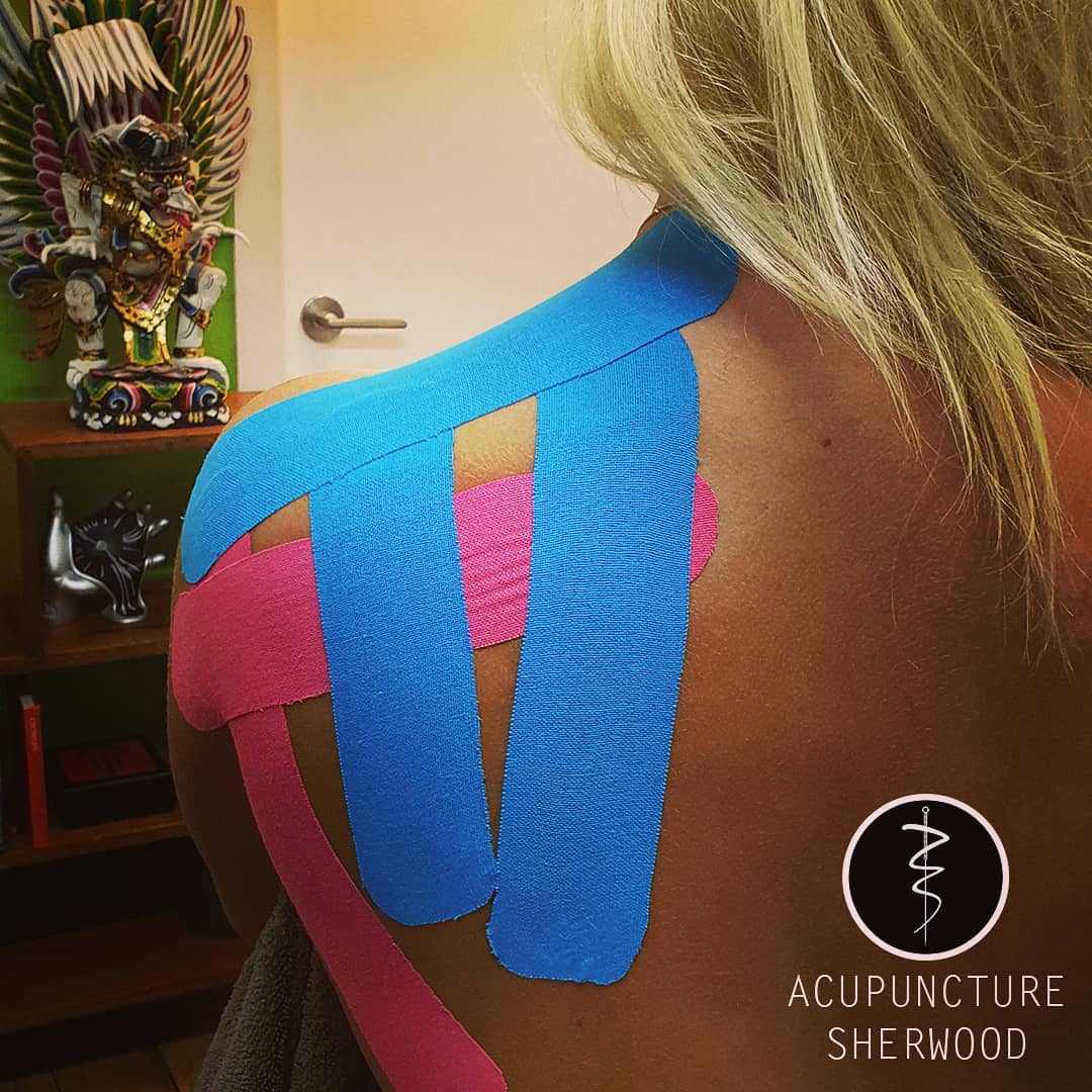 Intrigued?
#kinesiologytape #taping #sportstaping #acupuncture #acupuncturelife #acupuncturedoctor #acupunctureworks #acupunctureneedles #acupuncturerocks #acupuncturist #acupuncturebrisbane #shoulderpain #shoulderpaintreatment