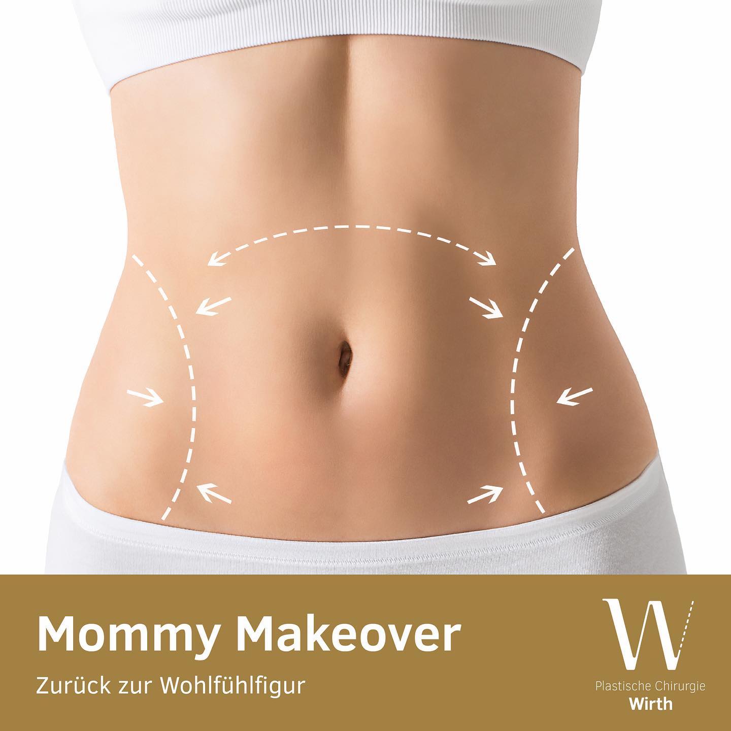 Mommy Makeover
Mami werden und sein ist eine wundervolle Erfahrung, die gleichzeitig alles auf den Kopf stellt: den Alltag, die Gefühlswelt, die Prioritäten und erst recht den Körper. Die körperlichen Veränderungen von Schwangerschaft und Stillzeit beschäftigen viele Frauen und oft stellt sich nach einer Zeit die Sehnsucht ein nach ihrem Körper vor der Geburt.
Ein Mommy Makeover korrigiert die Spuren von Schwangerschaft, Geburt und Stillzeit. Dabei wird in nur einer Operationssitzung eine ideale Kombination von verschiedenen Behandlungen durchgeführt, abgestimmt auf die körperlichen Voraussetzungen und individuellen Wünsche. Wie beispielsweise eine Behandlung der Brust (Straffung oder Vergrösserung), eine Bauchdeckenstraffung und eine Fettabsaugung – alles in der gleichen Sitzung.
Darum entscheiden sich Frauen für ein Mommy Makeover
• Wunsch nach einem flachen Bauch mit straffer Haut.
• Wunsch nach straffen Brüsten.
• Korrektur der vergrösserten Brustwarzen.
• Wunsch nach schlankerer und definierter Silhouette.
• Wunsch nach mehr Selbstbewusstsein und besserem Körpergefühl.
Mommy Makeover
Devenir et être une maman est une expérience merveilleuse, qui en même temps bouleverse tout, la vie quotidienne, les émotions, les priorités et plus encore le corps. Les changements physiques liés à la grossesse et à l'allaitement occupent de nombreuses femmes et souvent, après un certain temps, le désir de retrouver leur corps avant la naissance s'installe.
Un Mommy Makeover peut aider à corriger les traces de la grossesse, de la naissance et de l'allaitement. Une combinaison idéale de différents traitements est effectuée en une seule séance d'opération, adaptée aux conditions physiques et aux souhaits individuels. Par exemple, un traitement des seins (lifting ou augmentation mammaire), une abdominoplastie et une liposuccion, le tout dans la même séance.
C'est pourquoi les femmes optent pour un "Mommy Makeover”
• Désir d'un ventre plat avec un raffermissement de la peau.
• Désir de seins fermes.
• Correction de l'hypertrophie des mamelons.
• Désir d'une silhouette plus fine et plus définie.
• Désir de plus de confiance en soi et d'une meilleure conscience du corps