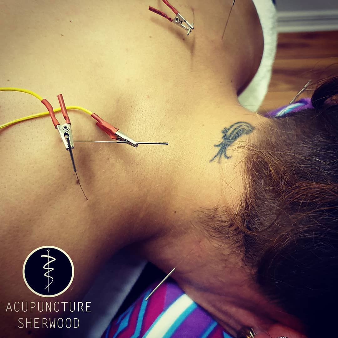Do you suffer from headaches that painkillers don't seem to touch? It could be they are coming from tightness and trigger points in the neck or shoulders. While medication may provide temporary relief, acupuncture can get straight to the point of where the pain is coming from 😆
#acupuncture #acupuncturelife #acupuncturedoctor #ancientmedicine #modernunderstanding #modernacupuncture #acupunctureworks #acupuncturerocks #acupuncturist #acupuncturebrisbane #neckpain #shoulderpain #headache #headacherelief #traps #electroacupunture #electroacupuntura