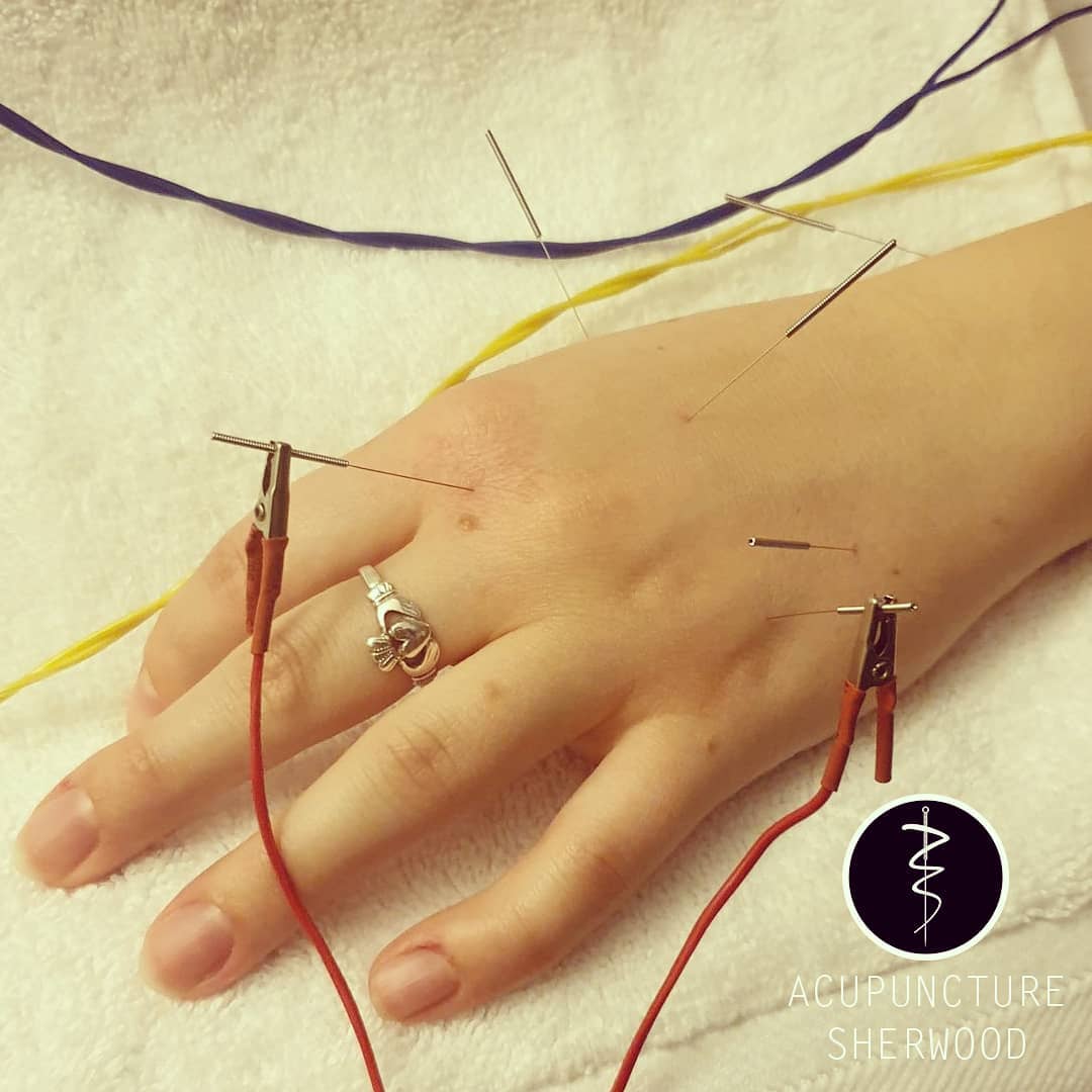 If you haven't tried acupuncture for RSI it's worth giving it a go. My main goal with the needles is to stimulate the body's acute inflammatory processes in order to reduce and manage the chronic inflammatory processes of repetitive strain injuries.
#acupuncture #acupuncturelife #acupuncturedoctor #acupunctureneedles #acupunctureworks #acupuncturerocks #acupuncturist #acupuncturebrisbane #handpainrelief #wristpainrelief #painrelief #naturalmedicine #rsi #repetitivestraininjury