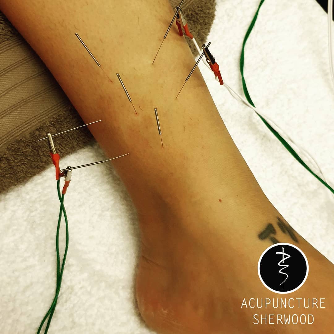 Injuries are often part of the process when delving deep into high impact sports such as martial arts. Fortunately a lengthy recovery does not always have to be. Here we work on relieving pain from impact on the lower leg.
#acupuncture #acupuncturelife #acupuncturedoctor #acupunctureworks #acupunctureneedles #acupuncturerocks #acupuncturist #acupuncturebrisbane #legpain #legpaintreatment #electroacupuntura #electroacupunture #tibialisanterior #soleus #martialarts
