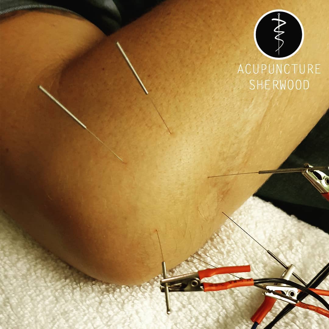For all sorts of elbow pain...
#acupuncturelife #acupunctureneedles #electroacupunture #acutepain #chronicpain #acupuncture #acupuncturedoctor #acupuncturist #elbowpain #elbowpainrelief #acupunctureworks #acupuncturerocks #acupuncturebrisbane #acupuntura
