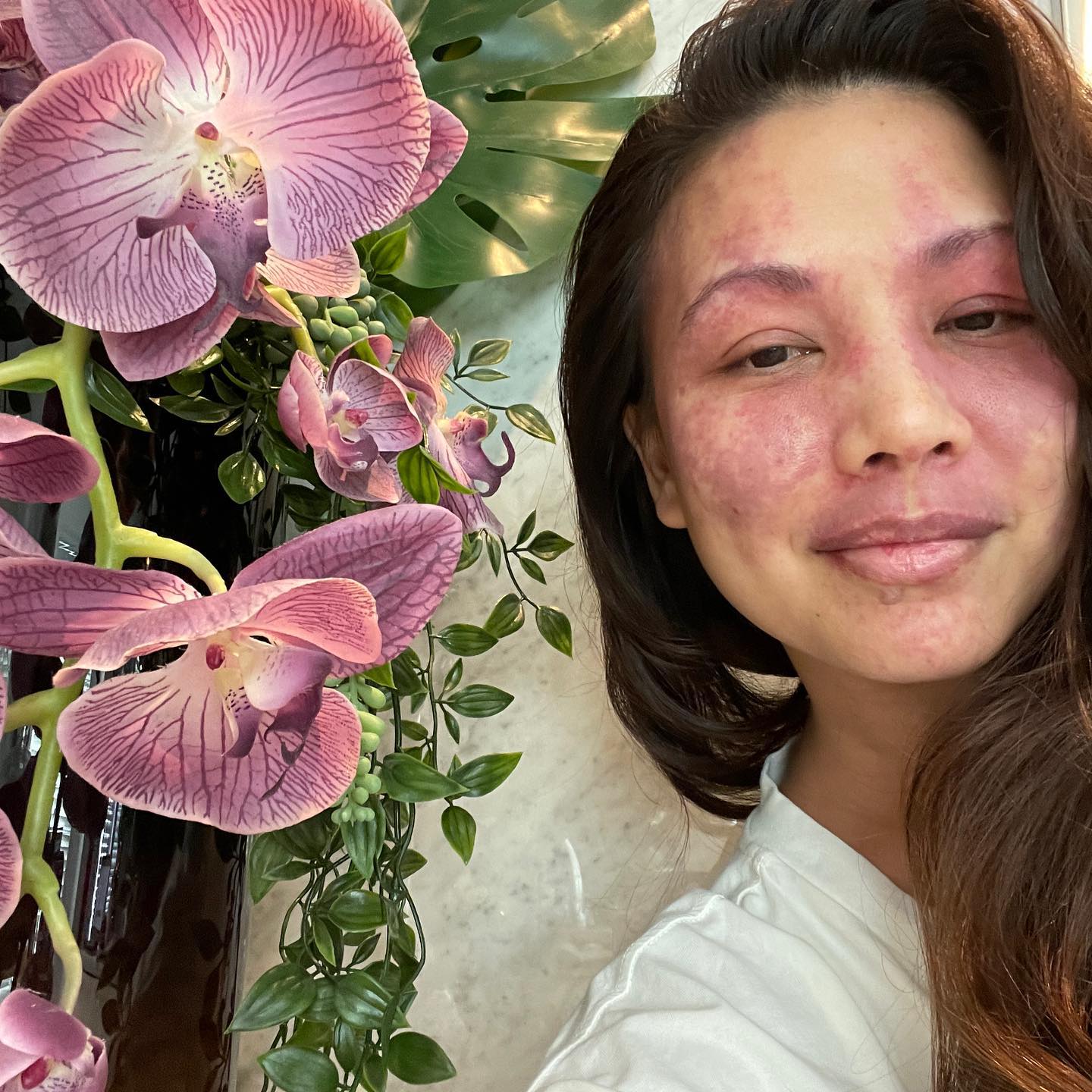 When the flowers in your kitchen match your face 😉#flowerpower p#portwinestainbirthmark #portwinestains #portwineproud #sturgeweber #nofilter