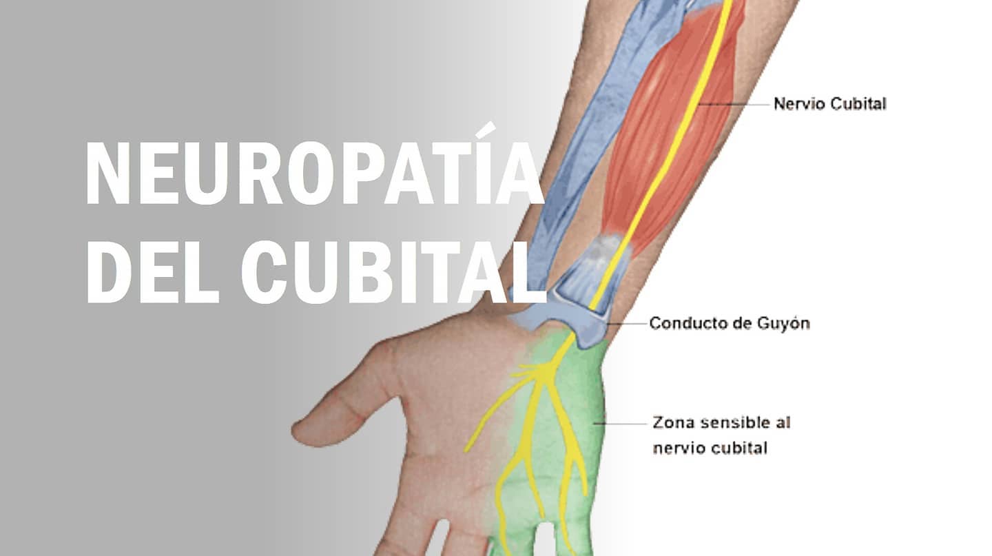 Siguiendo con la temática de las neuropatías de extremidad superior, hoy hablaremos acerca de la neuropatía del nervio cubital.
📝 Este nervio inerva principalmente a algunos músculos flexores del antebrazo y mano.
Sensitivamente se ocupa principalmente del CUARTO y QUINTO DEDO de la mano.
✅ Normalmente, cuando este nervio queda atrapado a nivel de codo, genera síntomas como HORMIGUEO, PÉRDIDA de FUERZA o incluso QUEMAZÓN en el 4 y 5 dedo.
👀 En las diapositivas podréis encontrar algunos CONSEJOS para su abordaje a nivel práctico, sin embargo, lo más sensato si te encuentras en esta situación es acudir a un PROFESIONAL de tu confianza que te oriente en el proceso a seguir.
Si te encuentras en esta situación y no sabes qué hacer, puedes CONSULTARME TU CASO y descubrir de que forma te puedo AYUDAR 📥.
#fisioterapia #dolor #nervio #cubitaltunnelsyndrome #hormigueo #rehabilitación #recuperacion #readaptacion #neuropatia #consejos #fisio #dosrius #canyamars #canmassuet #mataro #llinarsdelvalles #argentona #cardedeu #granollers