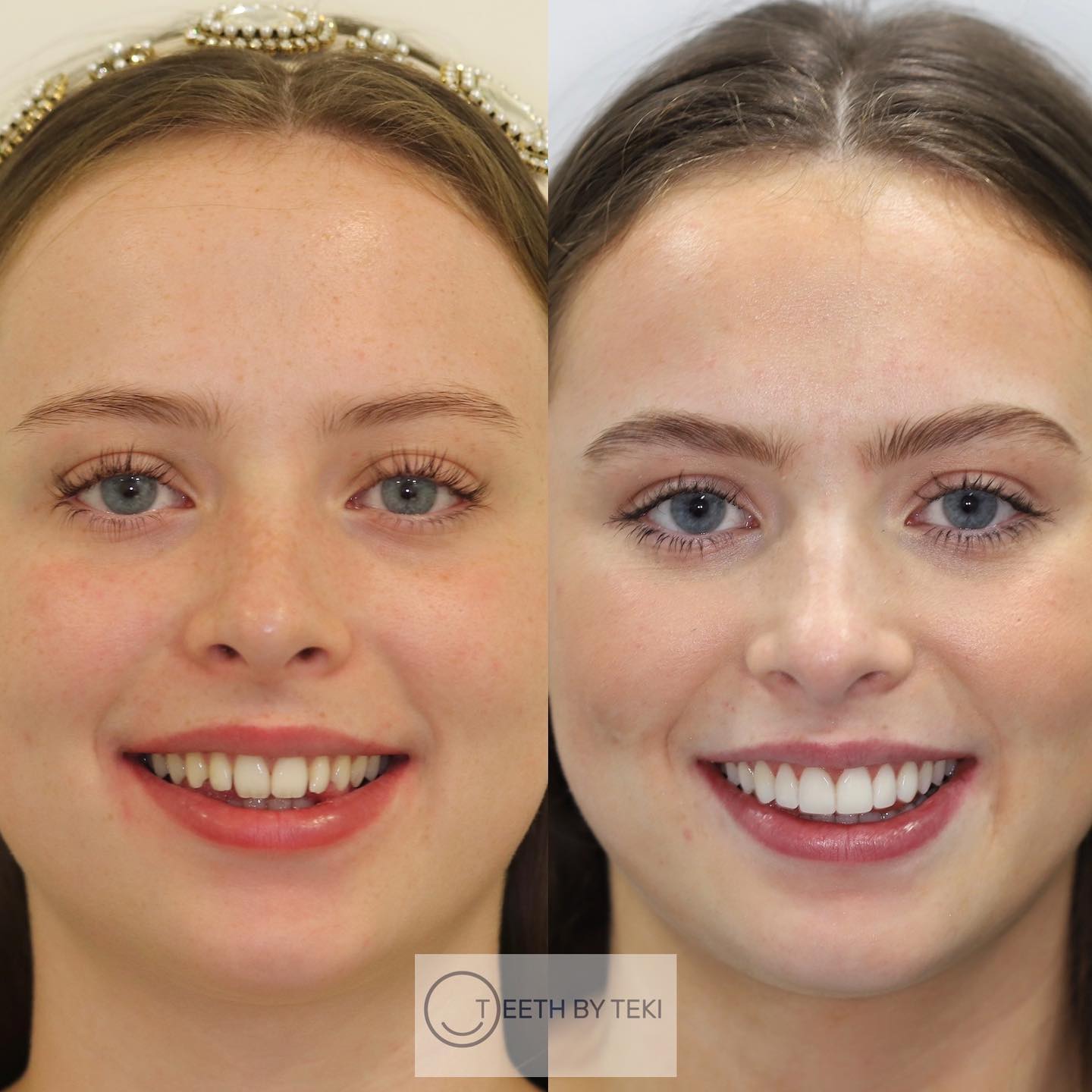 Invisalign, whitening and composite bonding ⚪️💙
.
.
Keeping smiles healthy
.
.
#teethbyteki #invisalign #compositebonding #yourstlyeyoursmile