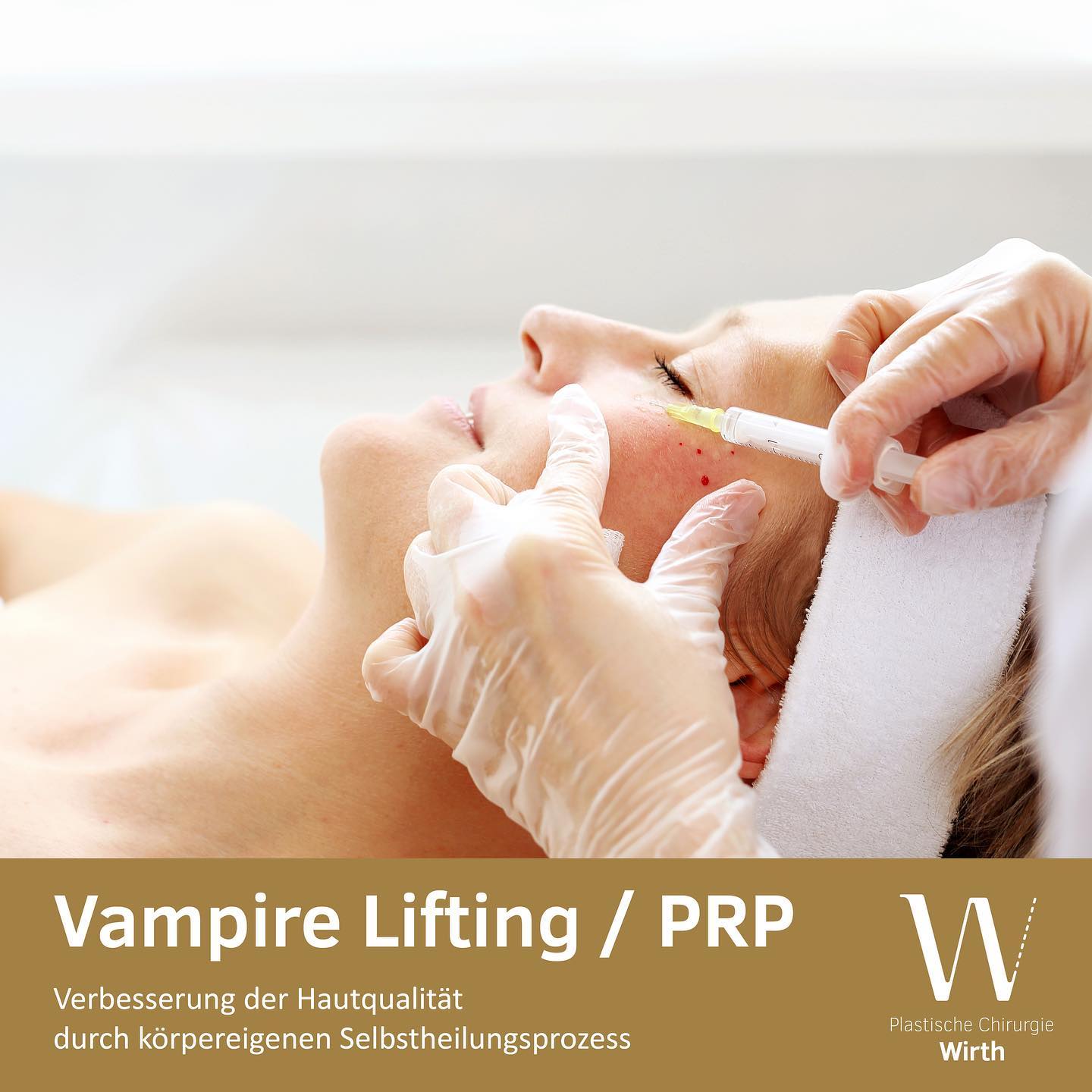 Vampire Lifting/PRP
Bei der PRP-(Platelet Rich Plasma – Plättchenreiches Plasma)-Methode handelt es sich um ein 100 Prozent natürliches Verfahren zur Regeneration der Haut. Bei diesem Verfahren wird dem Patienten eine geringe Menge an Eigenblut aus einer Armvene entnommen und in einem speziellen Verfahren aufbereitet, um anschliessend sofort als konzentriertes PRP wieder in oder unter die Haut injiziert zu werden.
Die entnommenen Blutplättchen (Thrombozyten) besitzen einen sehr hohen Gehalt an verschiedenen Wachstumsfaktoren und Zellhormonen. PRP hat die Fähigkeit, auf ganz natürliche Art und Weise den körpereigenen Selbstheilungsprozess zu beschleunigen und kann die Regeneration und Neubildung von Bindegewebe anregen. Beides führt dann zu einer Reduzierung von Falten und zu einer Verbesserung des Hautbildes.
Vampire Lifting/PRP
La méthode PRP (Platelet Rich Plasma) est une procédure 100 % naturelle pour régénérer la peau. Dans cette procédure, une petite quantité de sang du patient est prélevée dans une veine du bras et traitée dans une procédure spéciale pour être ensuite immédiatement réinjectée dans ou sous la peau sous forme de PRP concentrée.
Les plaquettes sanguines extraites (thrombocytes) ont une teneur très élevée en divers facteurs de croissance et hormones cellulaires. La PRP a la capacité d'accélérer le processus d'auto-guérison de l'organisme de manière tout à fait naturelle et peut stimuler la régénération et la nouvelle formation du tissu conjonctif. Les deux entraînent ensuite une réduction des rides et une amélioration de l'aspect de la peau.
#praxiswirth #drmedraphaelwirth #plastischechirurgie