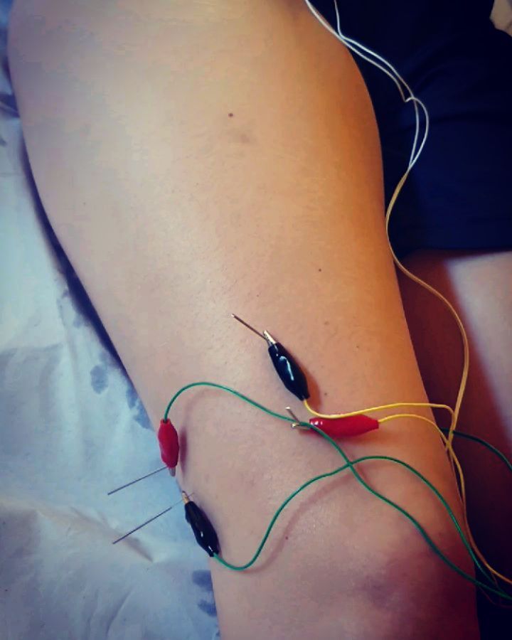 Abordaje de un caso clínico de Síndrome de la cintillo iliotibial y trocanteritis:
📝 Paciente con dolor en parte lateral de la rodilla, tercio distal del muslo y lateral de la cadera. Dos meses sin poder entrenar con su equipo de baloncesto (reinicio de actividad brusco después de los parones de actividad por el COVID19). Anteriormente le habían puesto plantillas por un dolor constante del peroneo lateral, no realiza una adaptación progresiva.
Le hacen una RMN y no se observa lesión alguna, solo algo de líquido intraarticular en la coxofemoral. Lo que aumenta sus dudas y no entiende que le sucede.
👨⚕️ Tratamiento:
➡️Educación acerca de la lesión
➡️Terapia manual
➡️Electroestimulación con @compexspain
Neuromodulación del nervio femoral, VE y TFL
‼️ GESTIÓN DE LA CARGA y reintroducción progresiva de la misma
✅ Evolución favorable, disminución de la sintomatología y mayor tolerancia al ejercicio.
#fisioterapia #dolor #sindromedelcorredor #cintillailiotibial #rodilla #rehabilitación #readaptacion #load #electroestimulacion #terapiamanual #educacion #diagnostico #casoclinico #fisioterapiainvasiva #fisioterapiadeportiva #basket #deporte #covid_19