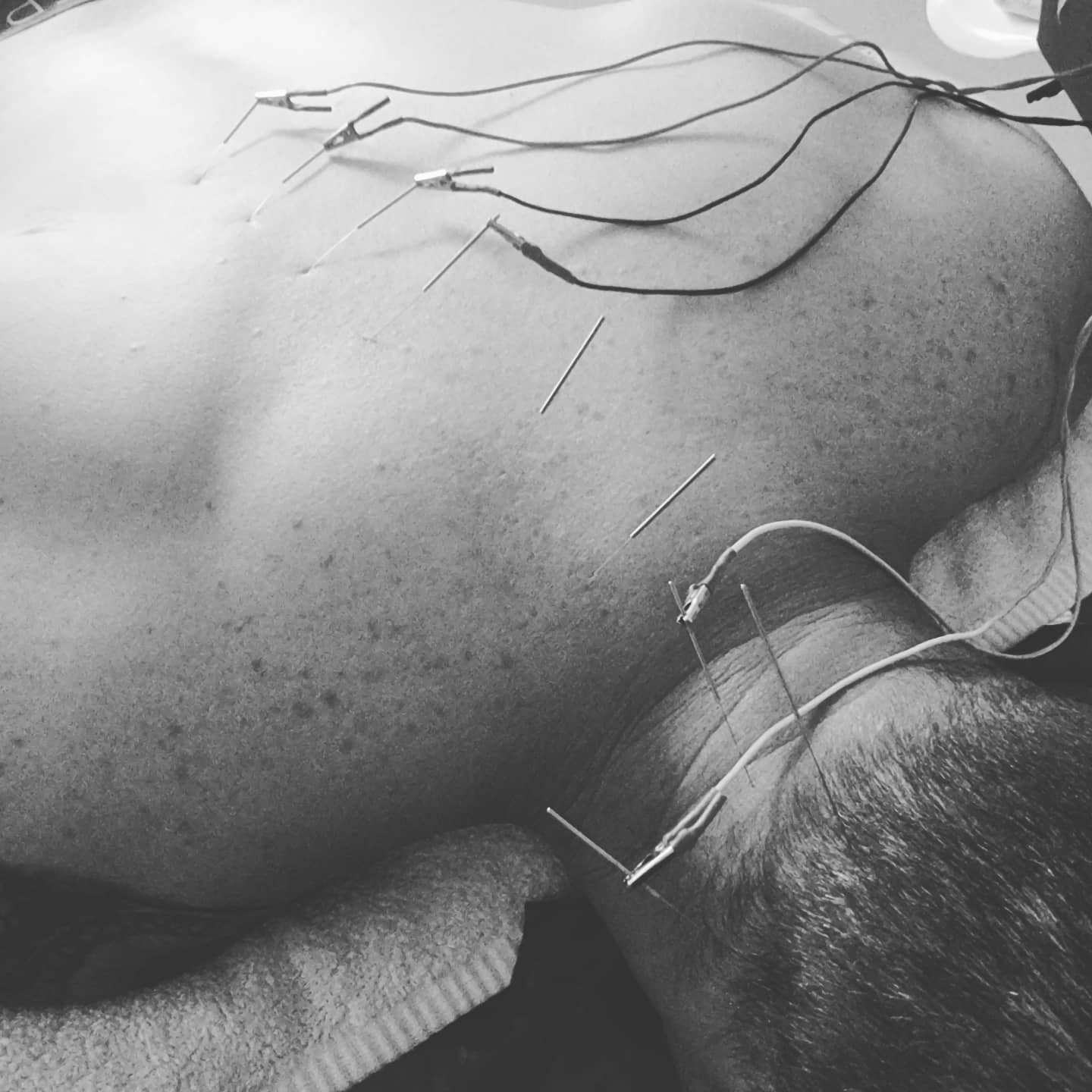 #acupuncture #acupuncturelife #acupuncturedoctor #ancientmedicine #modernunderstanding #modernacupuncture #acupunctureworks #acupuncturerocks #acupuncturist #acupuncturebrisbane #neckpain #shoulderpain #headache #headacherelief #traps #electroacupunture #electroacupuntura