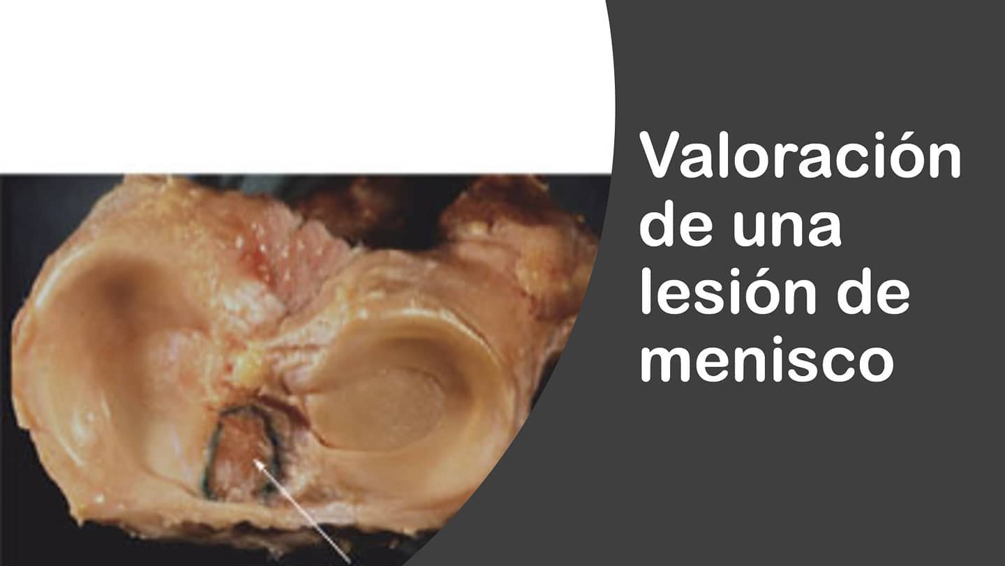 Hoy hablaremos acerca de una de las partes más importantes dentro del trabajo del fisioterapeuta, la valoración y diagnóstico fisioterapeutico y el razonamiento clínico. 🤔
Estos dos fundamentos nos ayudarán a determinar qué debemos hacer para ayudar a nuestro paciente.
En particular hoy os adjunto un conjunto de tests que utilizamos para valorar si existe o no patología del menisco y si debemos derivar al paciente al traumatologo🚩.
#fisioterapia #traumatologia #valoracion #diagnostico #menisco #meniscopatia #rodilla #dolor #rehabilitación #medico #cirugia #mcmurray #apley
