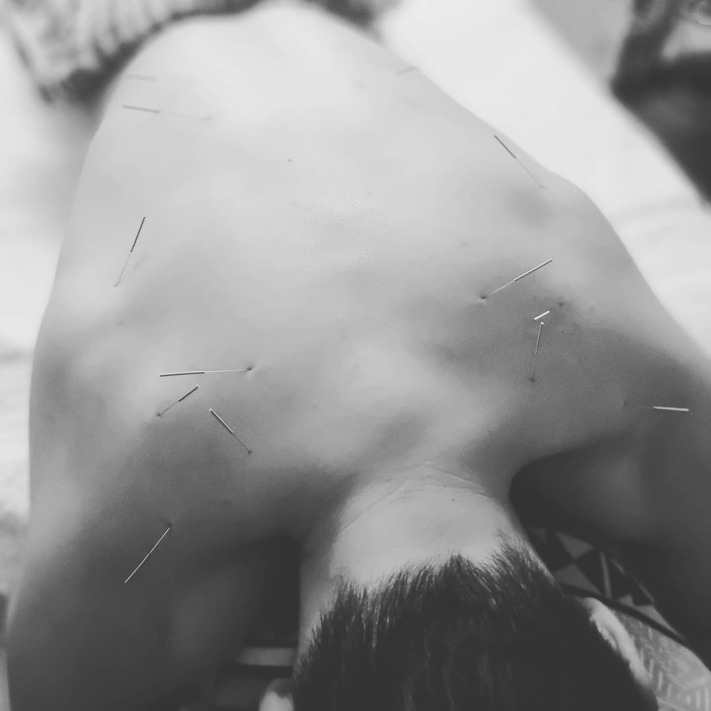 #acupuncture #acupuncturelife #acupuncturedoctor #ancientmedicine #modernacupuncture #acupunctureworks #acupuncturerocks #acupuncturist #acupuncturebrisbane #neckpain #shoulderpain #headache #headacherelief #traps #lowerbackpain #backtightness
#electroacupuntura #electroacupunture #tensmachine