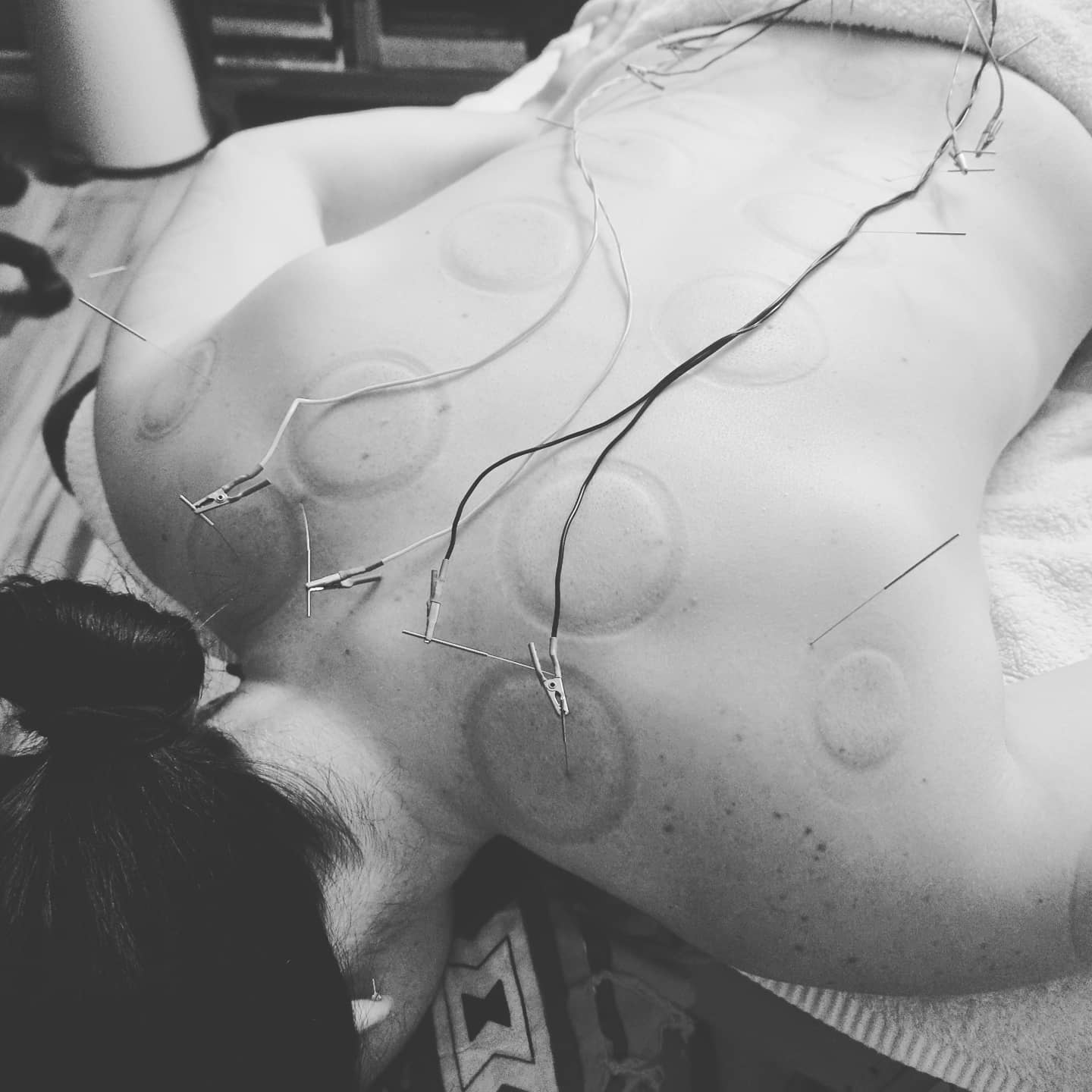 #acupuncture #acupuncturelife #acupuncturedoctor #ancientmedicine #modernunderstanding #modernacupuncture #acupunctureworks #acupuncturerocks #acupuncturist #acupuncturebrisbane #neckpain #shoulderpain #headache #headacherelief #traps #electroacupunture #electroacupuntura #cuppingtherapy #cupping #cuppingmassage