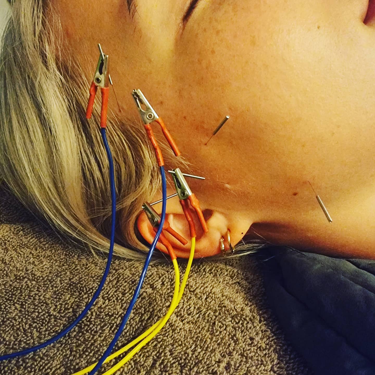 #acupuncture #acupuncturelife #acupuncturedoctor #ancientmedicine #modernunderstanding #modernacupuncture #acupunctureworks #acupuncturerocks #acupuncturist #acupuncturebrisbane #tmjd
#tmjpain #tmj #headache #headacherelief #tmjdisorder #electroacupunture #electroacupuntura