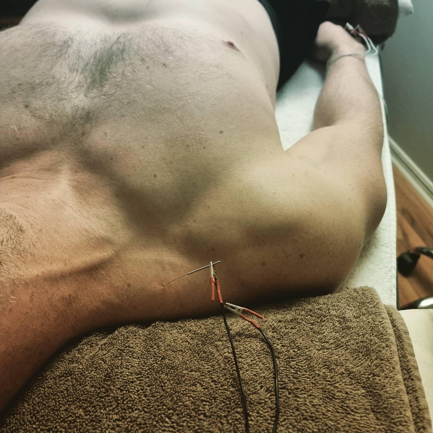 #acupuncture #acupuncturelife #acupuncturedoctor #ancientmedicine #modernunderstanding #modernacupuncture #acupunctureworks #acupuncturerocks #acupuncturist #acupuncturebrisbane #neckpain #shoulderpain #headache #headacherelief #traps #electroacupunture #electroacupuntura