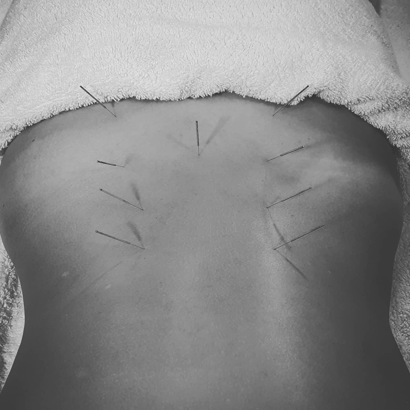 #acupuncture #acupuncturelife #acupuncturedoctor #ancientmedicine #modernunderstanding #modernacupuncture #acupunctureworks #acupuncturerocks #acupuncturist #acupuncturebrisbane #backpain #backpainrelief #acupuncturist #acupuncturebrisbane