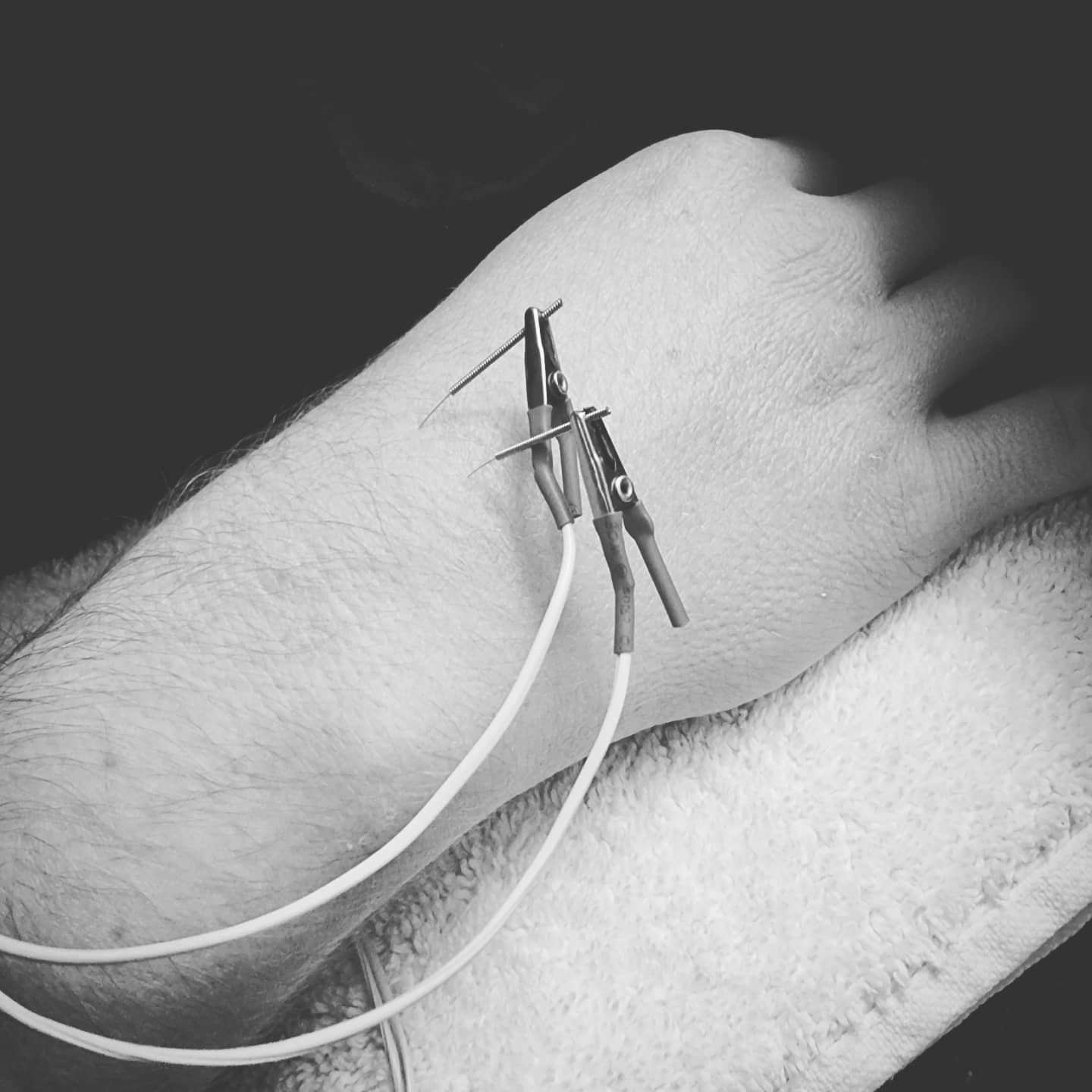 #acupuncture #acupuncturelife #acupuncturedoctor #acupunctureneedles #acupunctureworks #acupuncturerocks #acupuncturist #acupuncturebrisbane #handpainrelief #wristpainrelief #painrelief #naturalmedicine #rsi #repetitivestraininjury