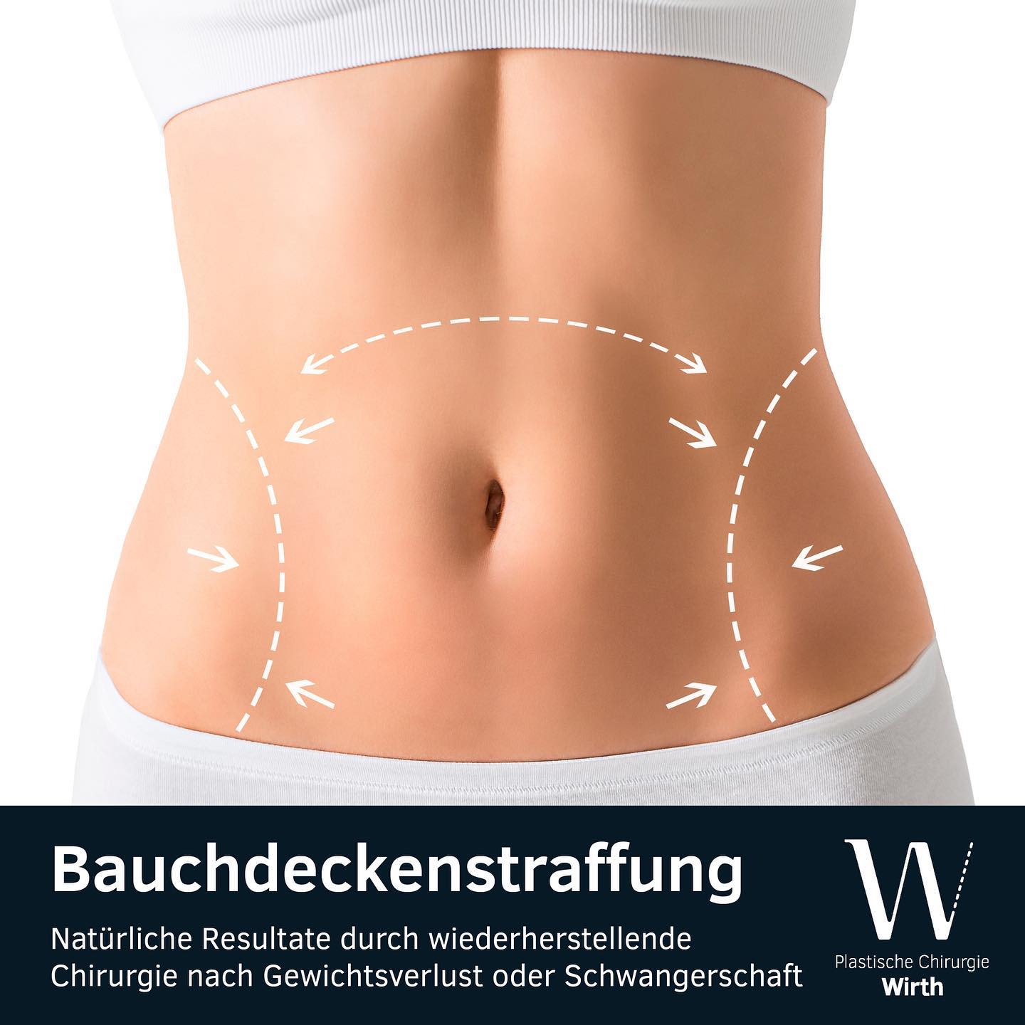 Bauchdeckenstraffung (Abdominoplastik)
Ein schlanker, straffer Bauch hat erheblichen Einfluss auf unser Wohlbefinden. Kommt es jedoch nach einer Schwangerschaft oder nach grösseren Gewichtsverlusten zu störenden Haut- und Gewebeüberschüssen, die selbst durch sportliche Aktivitäten und gezielte Ernährung nicht verringert werden können, kann eine operative Bauchstraffung (Abdominoplastik) helfen die Wunschfigur zu erreichen.
Grundsätzlich wird die Miniabdominoplastik von der eigentlichen Abdominoplastik unterschieden. Im Rahmen einer Miniabdominoplastik wird hauptsächlich der Unterbauch gestrafft. Der Bauchnabel wird bei dieser Operationstechnik nur selten gelöst. Bei einer großen Abdominoplastik wird neben dem Unterbauch auch der Oberbauch gestrafft. Hierbei muss auch der Nabel eine vollständig neue Position finden. Oft zeigt sich während der Operation, dass die geraden Bauchmuskeln etwas auseinander gewichen sind und der Bauch somit noch breiter erscheint. Dies lässt sich dann durch eine gleichzeitige Raffung der Muskeln gut beheben.
Lifting du ventre (abdominoplastie)
Un ventre mince et ferme joue un rôle essentiel pour notre bien-être. Si toutefois, après une grossesse ou une importante prise de poids restent des excédents cutanés et tissulaires, difficiles à faire disparaître même avec du sport ou une alimentation saine, un lifting du ventre (abdominoplastie) peut éventuellent vous aider à retrouver votre silhouette de rêve.
En général, on distingue la mini-abdominoplastie de la abdominoplastie proprement dite. Dans le cadre d’une mini-abdominoplastie, le lifting se concentre sur le bas du ventre, sans pour autant devoir toucher au nombril. Par contre, lors d’une grande abdominoplastie, la partie supérieure du ventre est également opérée. Le nombril doit alors être aussi repositionné. Au cours de l’opération, on constate souvant que les muscles droits de la paroi abdominale se sont déjà un peu écartés, donnant au ventre un aspect encore plus large. Cela peut être corrigé en même temps que l’on fait le raffermissement des muscles.
#praxiswirth #drmedraphaelwirth #plastischechirurgie