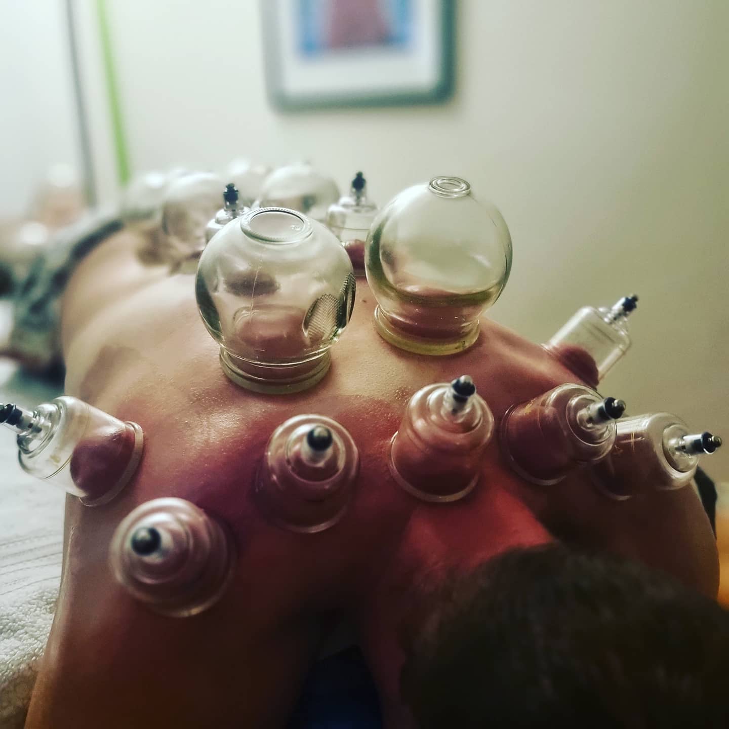 DM me to find out about how cups can help your body unwind and release tension.
#acupuncture #acupuncturelife #acupuncturedoctor #cuppingtherapy #cupping #cuppingmassage #tcm #traditionalchinesemedicine #musclepain #musclepainrelief #tightmuscles #relax #sportstreatment #myofascialrelease #myofascialdecompression