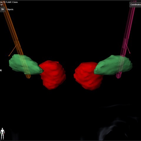 Deep brain stimulation may be highly effective for certain disorders such as Parkinson’s disease, tremor, dystonia, epilepsy, etc. Here is an example placement of bilateral electrodes to the subthalamic nucleus targets (green). At Houston Methodist, we use advanced imaging, intraoperative testing, and robotic-assistance to maximize lead placement accuracy.