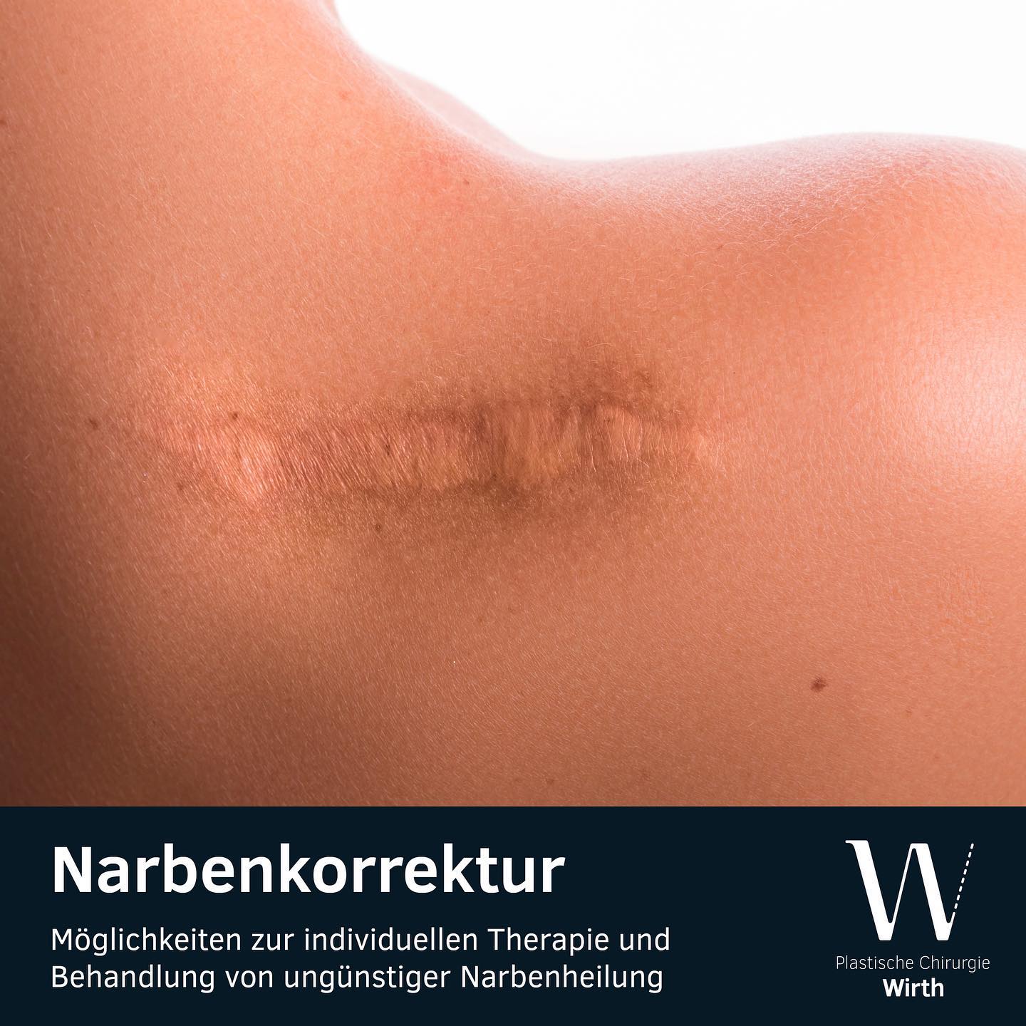 Narbenkorrektur
Narben können grundsätzlich nie komplett zum Verschwinden gebracht werden. Die Qualität der Narbenbildung ist jedoch bei jedem Patienten anlagebedingt vorgegeben. Es gibt Situationen, in denen die Narbenheilung durch äussere Einflüsse ungünstig verläuft oder die Narbe selbst ungünstig gelegen ist. In diesen Fällen kann eine operative Narbenkorrektur sinnvoll sein.
Mit einfachen Behandlungen wie Silikonpflaster, Kältetherapie, Kortisoninjektionen, Peeling, Needling und nicht zuletzt der operativen Korrektur stehen uns eine ganze Bandbreite an Therapien zur Verfügung, die individuell auf die Narbe und den Leidensdruck der betroffenen Person angepasst werden müssen. Die meisten Narbenkorrekturen können ambulant in Lokalanästhesie durchgeführt werden.
Correction de cicatrices
Il n’est en principe pas possible de faire disparaître complètement une cicatrice. La qualité de la formation des cicatrices varie en revanche d’un patient à l’autre et dépend de facteurs héréditaires. Dans certaines situations, la formation d’une cicatrice peut avoir été entravée par des influences extérieures. Dans d’autre cas, la cicatrice peut se trouver à un endroit peu judicieux. Une opération de correction peut alors s’avérer indiquée.
Avec des traitements simples comme les feuilles de silicone, la thérapie par le froid, les injections de cortisone, le peeling, le needling et, en dernier recours, la correction opérative, nous disposons d’une large palette de thérapies que nous pouvons adapter individuellement à la cicatrice à traiter et aux besoins du patient. La plupart des corrections de cicatrices peuvent être effectuées en ambulatoire et sous anesthésie locale.
#praxiswirth #drmedraphaelwirth #plastischechirurgie
