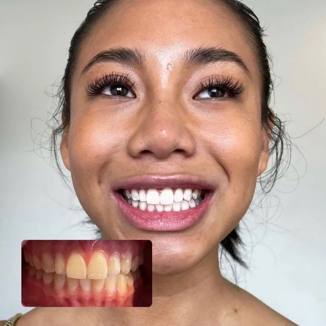 Klinik Tandblekning 
ERBJUDANDE 1490 KR (Ordinarie pris 4900 kr)
ONLINE TIDSBOKNING
www.DentalClinicSweden.com 🔺️ BOKA FÖR 2 PERSONER & FÅ YTTLIGARE 200 KR RABATT!
 #tandblekningstockholm #TandblekningStockholm #KlinikTandblekning #TandblekningGöteborg #TandblekningUppsala #TandblekningUtbildning #TandblekningsUtbildning