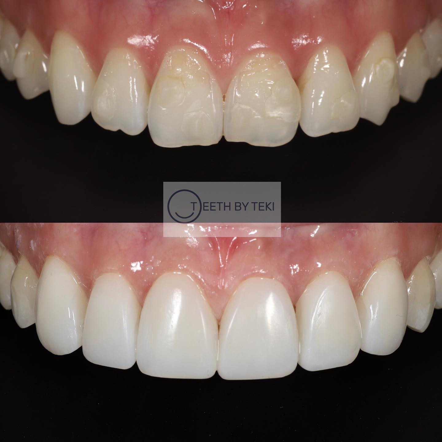 Composite bonding after Invisalign ⚪️💙
.
.
#teethbyteki #compositebonding #invisalign