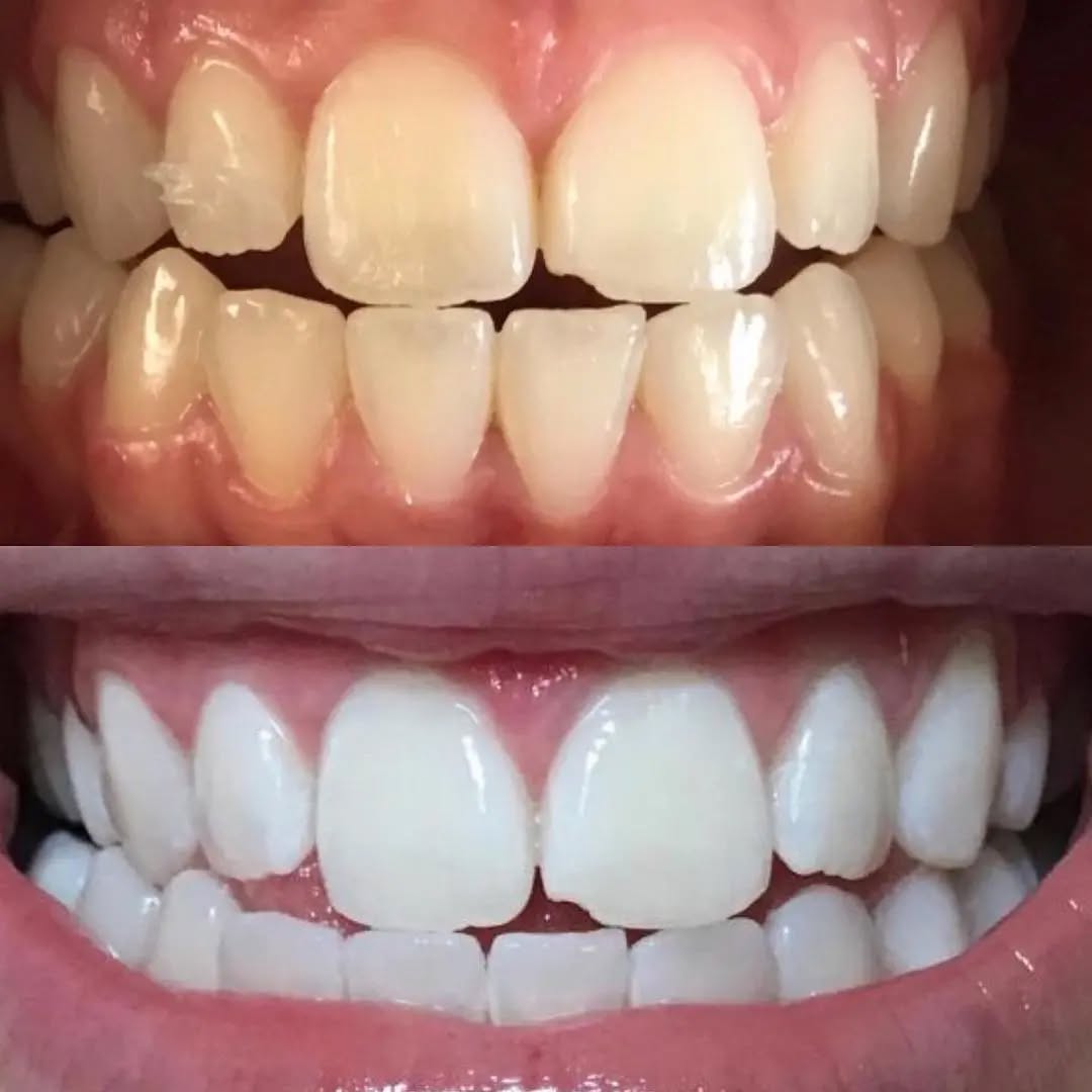 Klinik Tandblekning 
ERBJUDANDE 1490 KR (Ordinarie pris 4900 kr)
ONLINE TIDSBOKNING
www.DentalClinicSweden.org 🔺️ BOKA FÖR 2 PERSONER & FÅ YTTLIGARE 200 KR RABATT!
 #tandblekningstockholm #TandblekningStockholm #KlinikTandblekning #TandblekningGöteborg #TandblekningUppsala #TandblekningUtbildning #TandblekningsUtbildning