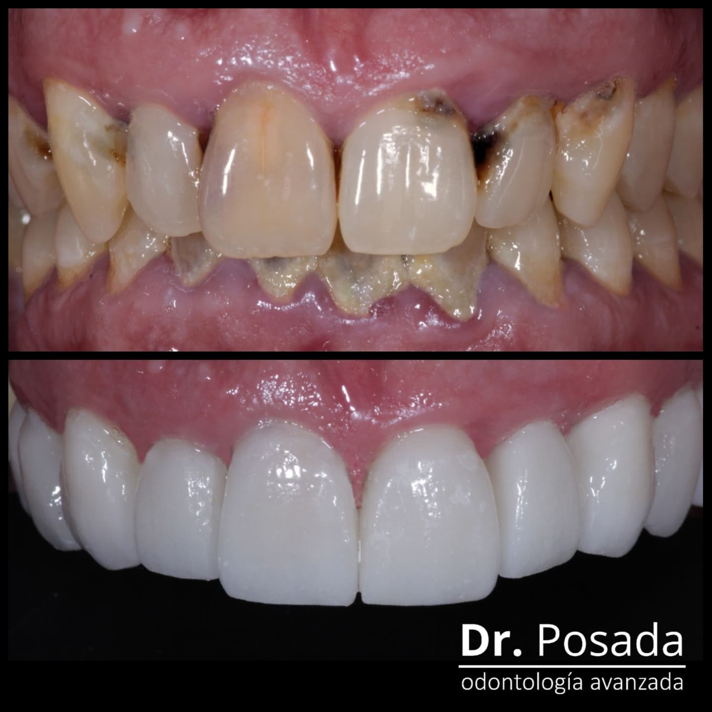 💫💫Let the #smile be your way of life; at @dr.posada we provide our patients with top quality and beautiful results.😁😁
✔ Patient from the #newyork #unitedstates 🇺🇸
🤯 Patient Objective: Healthier teeth and nicer smile
🔝results time achievement: immediate
🇨🇴 Location: #bogota colombia
🌇 Trip time: 5 days
🦷material: lithium disilicate E.Max designed by computer and robotically designed
🤩durability: 15 to 20 years
VIRTUAL ASSESSMENT
DM
📲📲WhatsApp +57 3046529022
☎️☎️601 7552046
.
.
.
.
.
.
.
.
.
.
.
.
.
.
#dientesblancos #diseñodesonrisacolombia
#sonrisaperfecta #clientesatisfecho
#disilicato #diseñodental #diseñodigital #dientessanos #topdoctors #naturalsmile #toptensmiles #inlab #losmejoresdiseñosdesonrisa #smiledesign #vennershollywod #veeners #happy #topbestvennersincolombia @miami @orlando @canada @fortlauderdalebeach @españa @losangeles__california
@houston