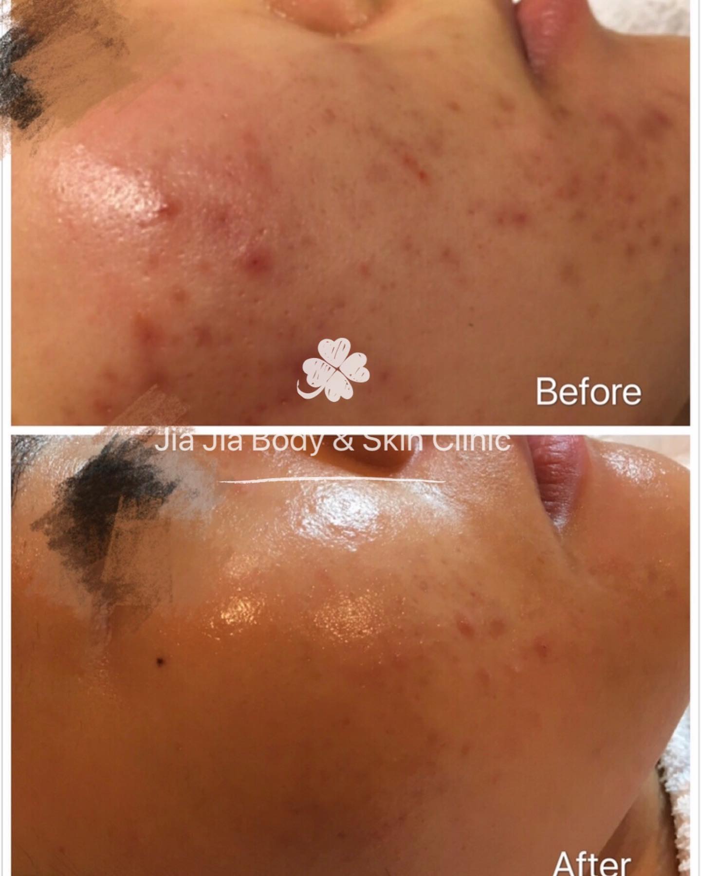 😟Concern - Acne, Acne Marks & Uneven skin tone
❓How did we treat it - signature acne treatment & Peel
😮Results - After 6 sessions
⏰ Time taken - 3 months
👨The area treated - Face
📋 Note - Results may vary person to person
#Acne is something anybody would avoid if one had a choice. It also contributes to emotional distress. However, acne can be successfully treated with the right #medication and #treatments. It is always ideal to consult an expert therapist especially when the acne is severe. Acne can also cause scarring and leave red or #brownmarks and #unevenskin tone, which should be addressed only after a person’s active acne is under control.
Here is our client who got the combination acne
#acnetreatment #acnepositivity #acnesolutions #acnescars #acnemarks #adultacne #clearskin #exfoliation #acnejourney #skincareobsessed #skinblemishes #acneproblems #acnetips #realresults #realresultsrealpeople #beforeafter #skin #pimples #acneproneskin #acnecommunity #sensitiveskin #acnefree
