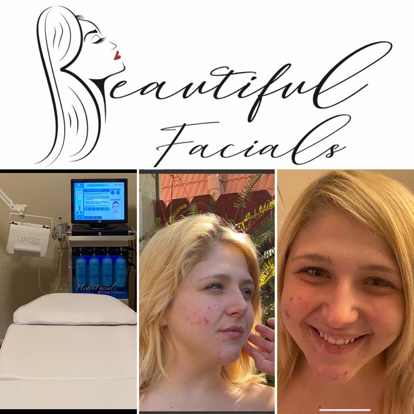 🦋One Treatment 🦋
#hydrofacial #facialspa #ledlighttherapy #LightStim #facials