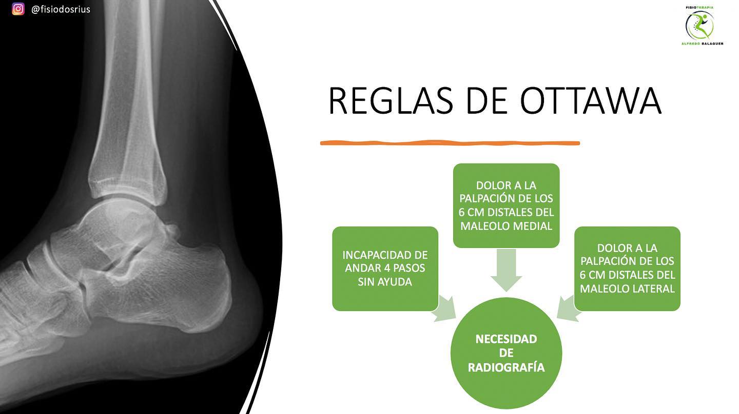 ✔️¿Quieres saber cuándo deberías ir al médico a hacerte una radiografía si te tuerces el tobillo?
Hoy compartimos contigo una de las reglas más básicas que te ayudarán a saber cuando es necesario hacerte una radiografía.
🔴Si tienes dolor a la palpación de los 6cm distales del maleolo medial (hueso cara interna del tobillo) o del maleolo pereoneal (hueso de la cara externa del tobillo)
🔴Si no eres capaz de dar 4 pasos seguidos sin ayuda
⚠️Si se cumple alguna de las condiciones anteriores, es aconsejable que te hagas una radiografía para descartar lesión ósea.⚠️
#fisioterapia #dolor #lesionesdeportivas #lesión #tobillo #esguince #esguincedetobillo #radiografia #medico #fracturas #rehabilitacion #readaptacion #readaptaciondeportiva