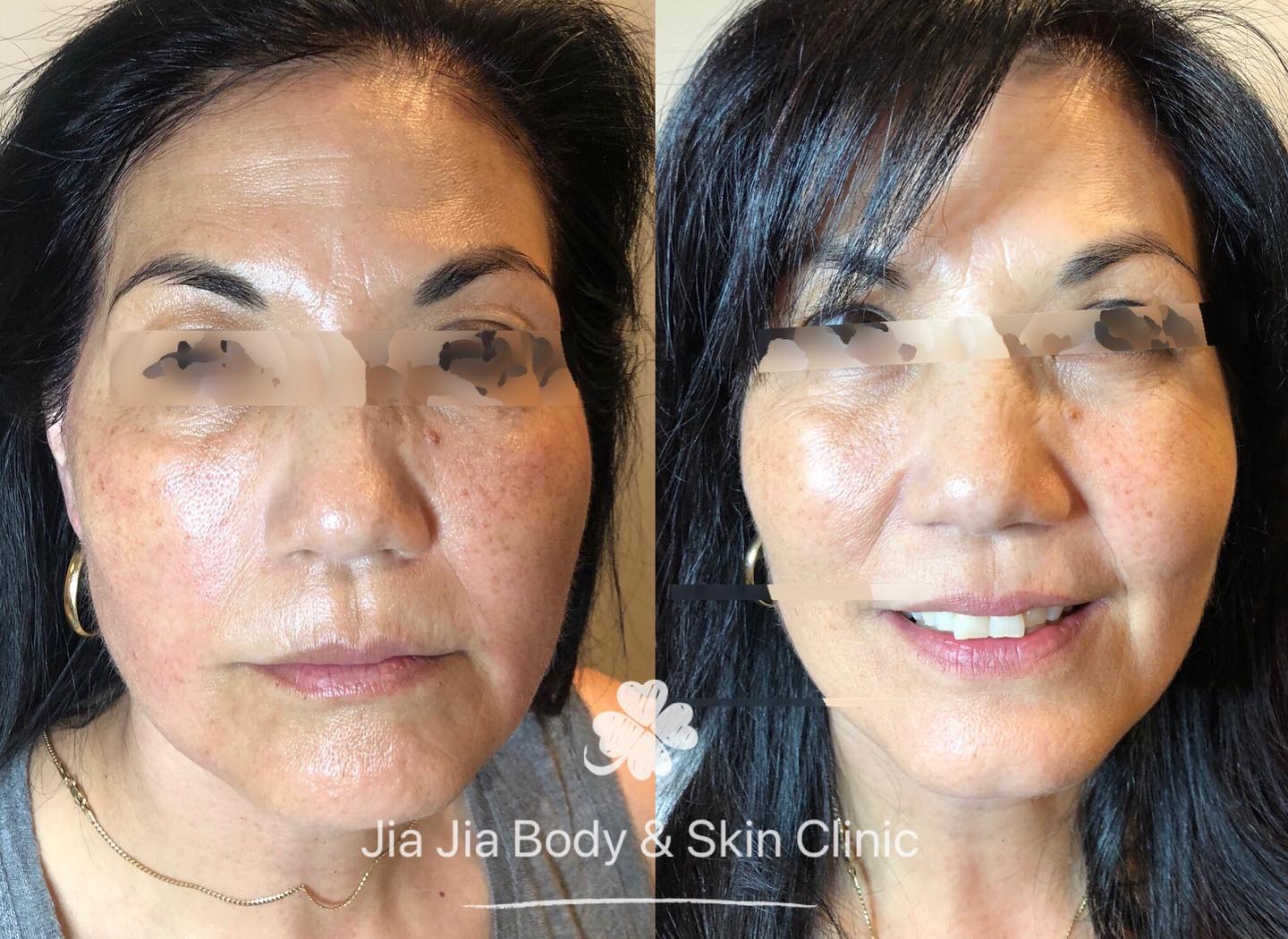 Two weeks after Skin tightening treatment, looks amazing 🤩