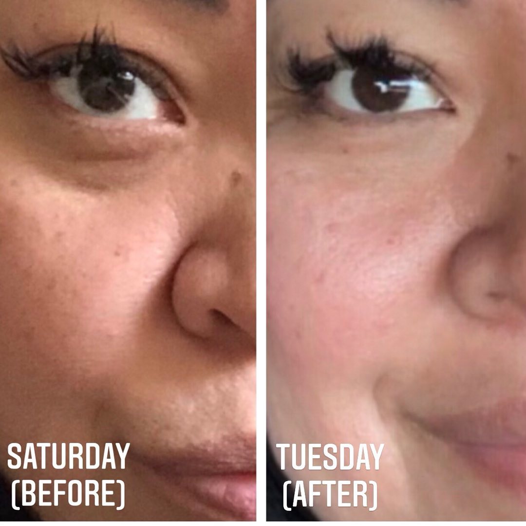 After one Derma Hydra facial with LightStim therapy at Beautiful Facials
Follow my business page
@beautiful.facials