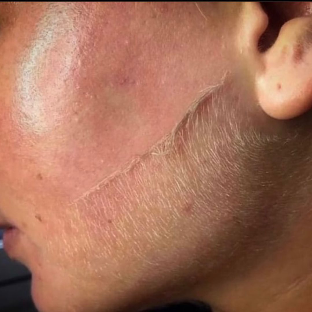 By combining dermaplaning and
HydraFacial together, these two facial
rejuvenation treatments address
virtually every skin concern your
clients could possibly have.
Dermaplaning begins to unclog pores
by gently removing dead skin cells and
other impurities from your skin's
surface.
Then, a HydraFacial deeply cleans,
exfoliates, hydrates and protects your
skin. The targeted serums will be able
to penetrate better and more evenly,
giving you the ultimate healthy-skin
glow!
#dermaplanepro #dermaplane
#dermaplaning #oilplaning
#exfoliation #esthetician #esthetics
#facials #skintips