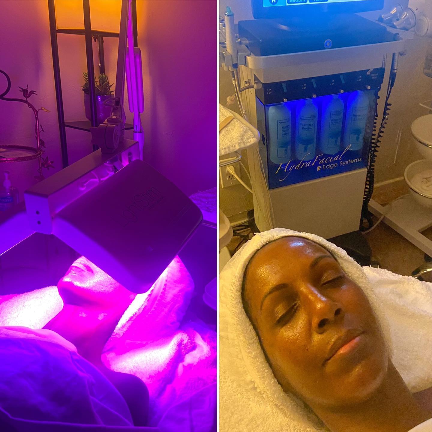 Beautiful results at Beautiful Facials 🦋🦋🦋
HydraFacial with LightStim