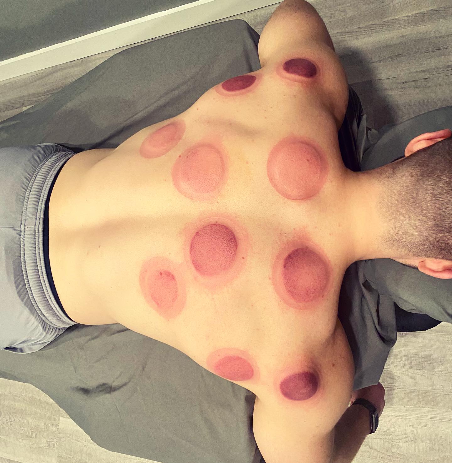 Cupping has been practiced for thousands of years. It originated as a form of Egyptian and Chinese medicine.
Though the after effects can look a bit odd, it can be an excellent treatment modality to increase micro circulation in order to stimulate the bodies natural healing process.
Interested in adding it to your treatment sessions? Get in touch with us today!
#sportsmedicine #manchesternh #physicaltherapy #athletictraining #bedfordnh #alternativemedicine #cupping #staymobile
