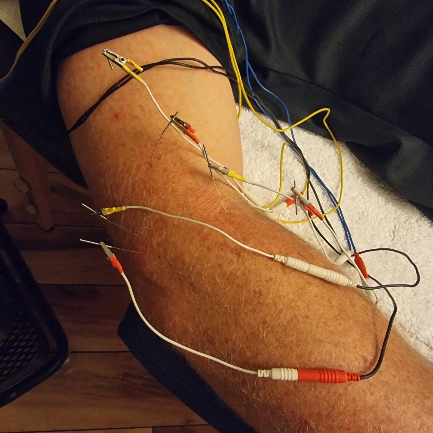 Treatment for tennis elbow (lateral epicondylitis)
>>>
#acupuncturelife #acupunctureneedles #electroacupunture #acutepain #chronicpain #acupuncture #acupuncturedoctor #acupuncturist #elbowpain #elbowpainrelief #acupunctureworks #acupuncturerocks #acupuncturebrisbane #acupuntura #tenniselbow #tenniselbowtreatment #lateralepicondylitis