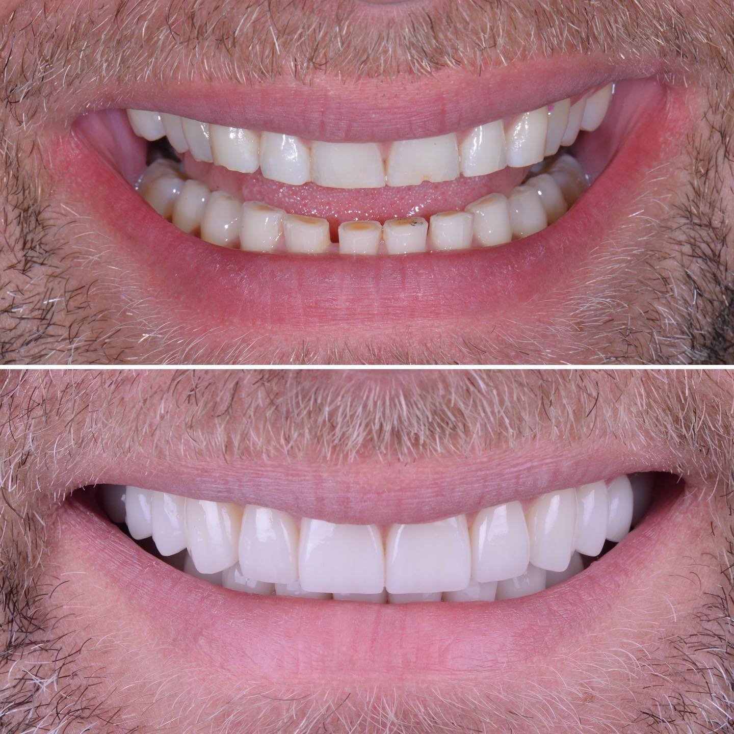 Great example of a functional full mouth rehabilitation. The condition of the patients teeth was not consistent with the patients age. Due to a wrong bite the teeth wore down at an accelerated speed. Hence the bite was corrected and teeth restored - as usual in the best possible way exceeding the patients expectation 😄
#abudhabidentist #dentistabudhabi #dubaidentist #dentistdubai #smiledesign #digitalsmiledesign #zahnarzt #dentist #estheticdentistry #veneers #3shape #highenddentistry #digitaldentistry #predictibledentistry #dentaltourism #adent #veneersabudhabi #abudhabiveneers #veneersdubai #fullmouthrehabilitation #biomimeticdentistry #functionaldentistry #kois #koisappliance