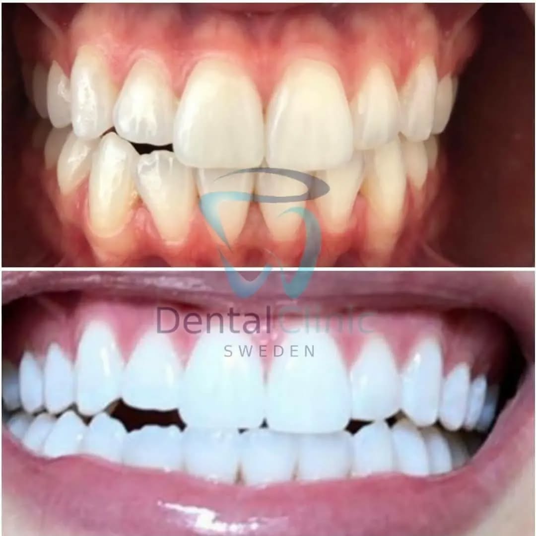 Klinik Tandblekning 
ERBJUDANDE 1490 KR (Ordinarie pris 4900 kr)
ONLINE TIDSBOKNING
www.DentalClinicSweden.org 🔺️ BOKA FÖR 2 PERSONER & FÅ YTTLIGARE 200 KR RABATT!
 #tandblekningstockholm #TandblekningStockholm #KlinikTandblekning #TandblekningGöteborg #TandblekningUppsala #fillersstockholm #russianlips #russianlipsstockholm #smink #håruppsättning #tandblekning #hollywoodsmile #hollywoodsmilesverige #hollywoodsmilestockholm #TandblekningUtbildning #fransar #fransarstockholm #TandblekningsUtbildning