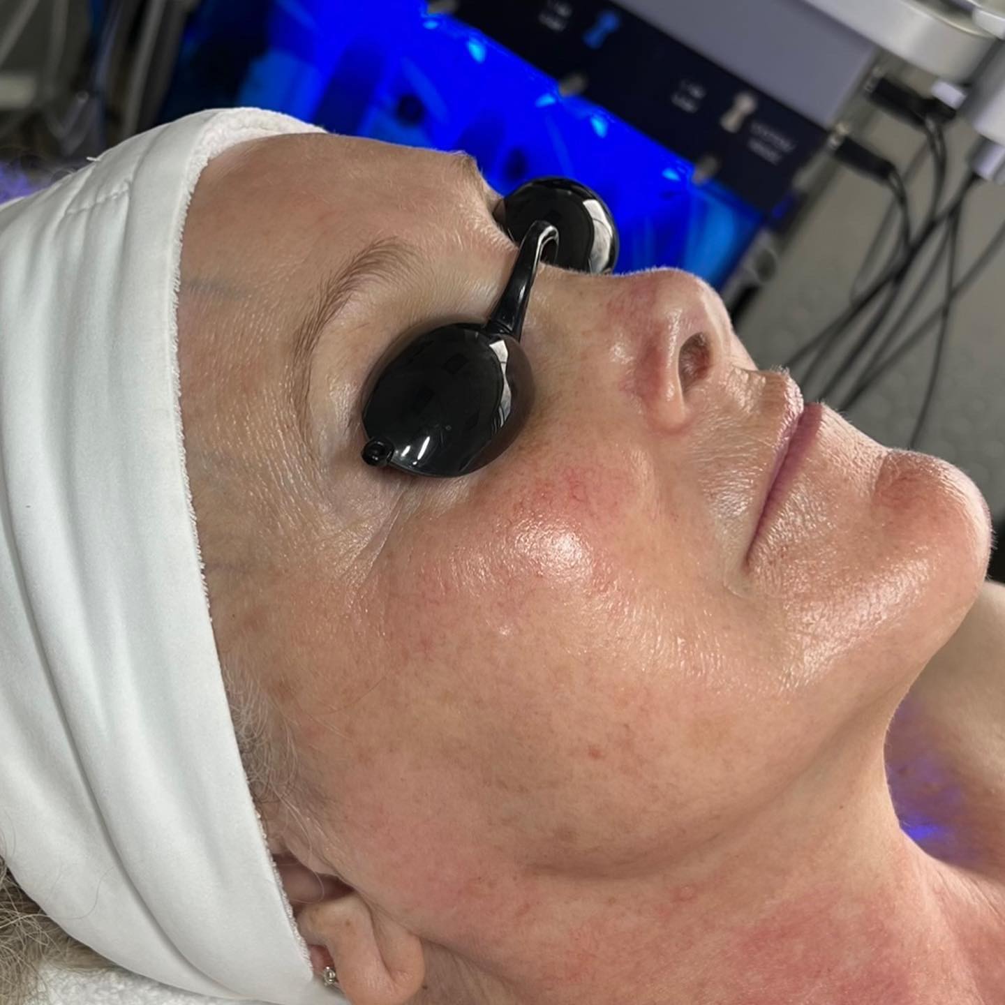 ☀️Get your HydraFacial Summer GLOW on💧
✨Brighten your complexion while reducing the appearance of fine lines and pores.
💧Replenish moisture and nutrients back into the skin by adding a blend of antioxidants & peptides, hyaluronic acid leaving the skin radiant.
Check out these before & after results after just one Platinum Hydrafacial treatment! 🤩.
📞Call the clinic to schedule your @hydrafacial today
#509.346.6165