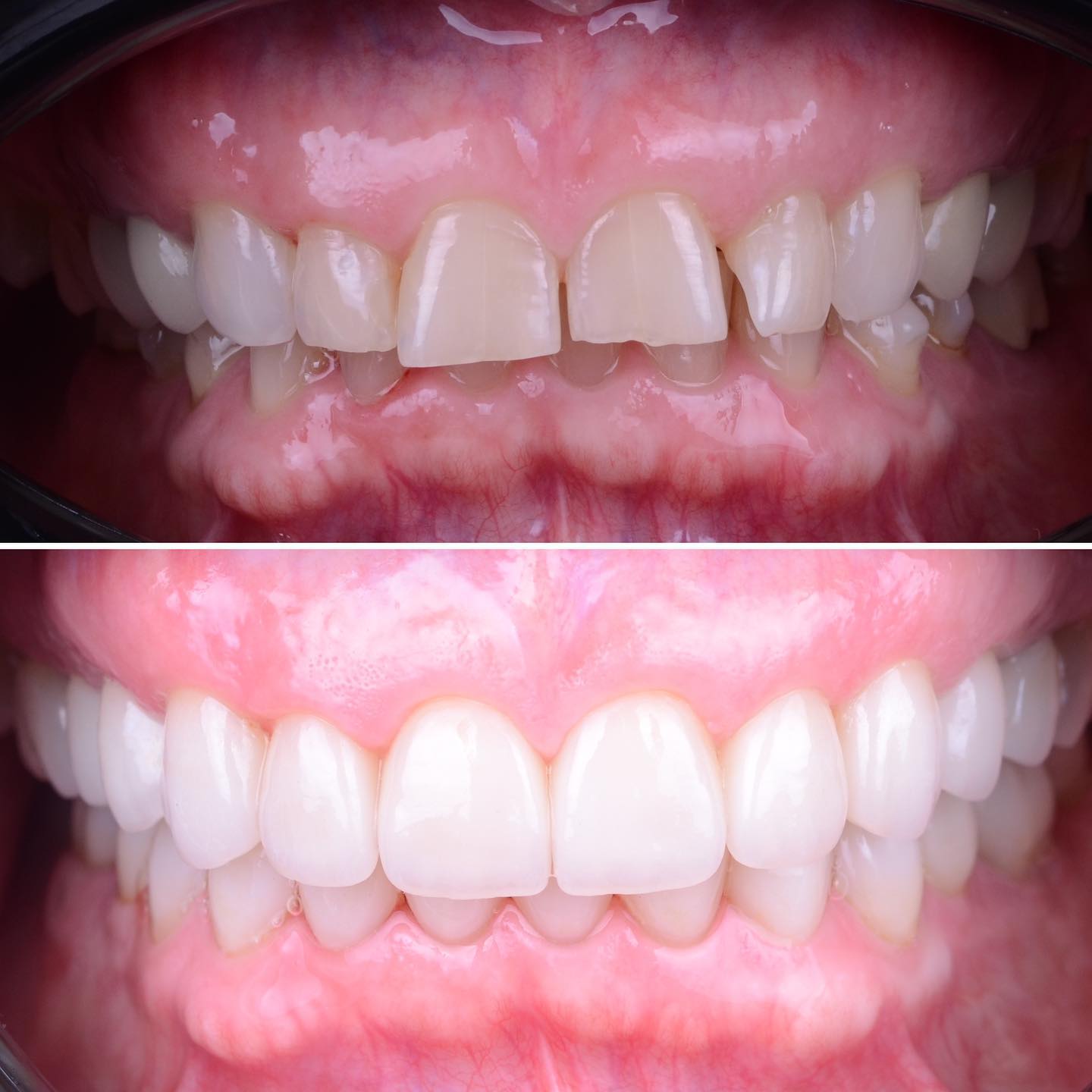 Full mouth rehabilitation involving correction of the bite with the help of a Kois appliance and Orthodontic treatment, then followed with a new set of crowns and veneers.
A very important aspect about any procedure is to make sure the function is right. This will predict the comfort of the patient and the longevity of the rehabilitation. Besides that it can greatly improve the general well-being of the patient especially in case of TMJ/CMD symptoms.
#abudhabidentist #dentistabudhabi #dubaidentist #dentistdubai #smiledesign #digitalsmiledesign #zahnarzt #dentist #estheticdentistry #veneers #3shape #highenddentistry #digitaldentistry #predictibledentistry #adent #veneersabudhabi #abudhabiveneers #veneersdubai #fullmouthrehabilitation #biomimeticdentistry #functionaldentistry #tmj #tmd #cmd #jawpain