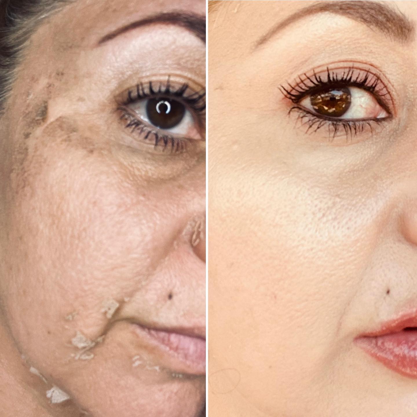 TCA Chemical Peel results at Beautiful Facials 🥰
#dermodality #TCA #facials #chemicalpeel