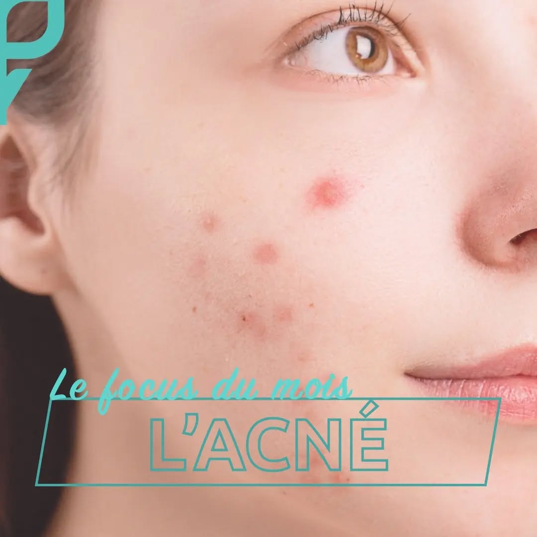 Vous souffrez d'acné et voyez réapparaitre des boutons sur votre peau ? C'est normal. Pendant l'été, notre peau à tendance à s'épaissir en bloquant la remontée de sébum, et par conséquent l'apparition des boutons. Mais une fois l'été terminé, l´excès accumulé ressurgit et c'est pour cela que vos boutons réapparaissent.
Comment calmer une poussée de boutons inflammatoires ?
Une goutte de cica-concentré va permettre de calmer l´inflammation de votre/vos bouton(s) et va également le(s) faire disparaître plus rapidement grâce aux huiles essentielles particulièrement actives qui sont contenues dans cica-concentré.
Vous pouvez également utiliser cica-concentré sur vos marques d´acné. De manière locale, vous pouvez appliquer quelques gouttes sur vos cicatrices tous les soirs. Les marques seront estompées et vous retrouverez le confort de votre peau.
Pour en savoir plus sur les actions de cica-concentré, allez sur notre site : www.ianthis.com
#santédelapeau #dailyroutine #madeinfrance #ianthislab #cicaconcentre #huilesessentielles #peauxsensibles #naturel