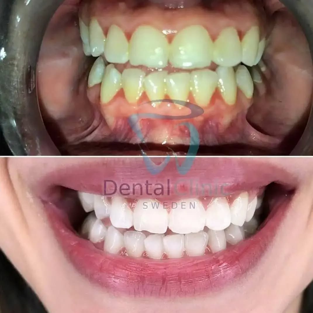 Klinik Tandblekning 
ERBJUDANDE 1490 KR (Ordinarie pris 4900 kr)
ONLINE TIDSBOKNING
www.DentalClinicSweden.org 🔺️ BOKA FÖR 2 PERSONER & FÅ YTTLIGARE 200 KR RABATT!
 #tandblekningstockholm #TandblekningStockholm
#tandblekningliljeholmen #liljeholmen #stockholm #KlinikTandblekning #TandblekningGöteborg #TandblekningUppsala #TandblekningUtbildning #TandblekningsUtbildning