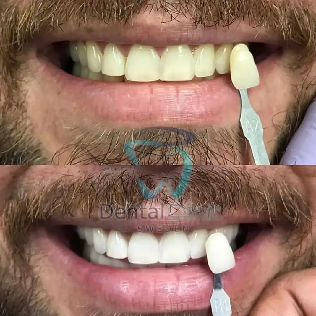 Klinik Tandblekning 
ERBJUDANDE 1490 KR (Ordinarie pris 4900 kr)
ONLINE TIDSBOKNING
www.DentalClinicSweden.org🔺️ BOKA FÖR 2 PERSONER & FÅ YTTLIGARE 200 KR RABATT!
 #tandblekningstockholm #TandblekningStockholm #stockholm #liljeholmen #KlinikTandblekning #TandblekningGöteborg #TandblekningUppsala #TandblekningUtbildning #TandblekningsUtbildning