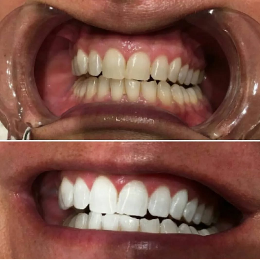 Klinik Tandblekning 
ERBJUDANDE 1490 KR (Ordinarie pris 4900 kr)
ONLINE TIDSBOKNING
www.DentalClinicSweden.org🔺️ BOKA FÖR 2 PERSONER & FÅ YTTLIGARE 200 KR RABATT!
 #tandblekningstockholm #TandblekningStockholm #stockholm #liljeholmen #KlinikTandblekning #TandblekningGöteborg #TandblekningUppsala #TandblekningUtbildning #TandblekningsUtbildning